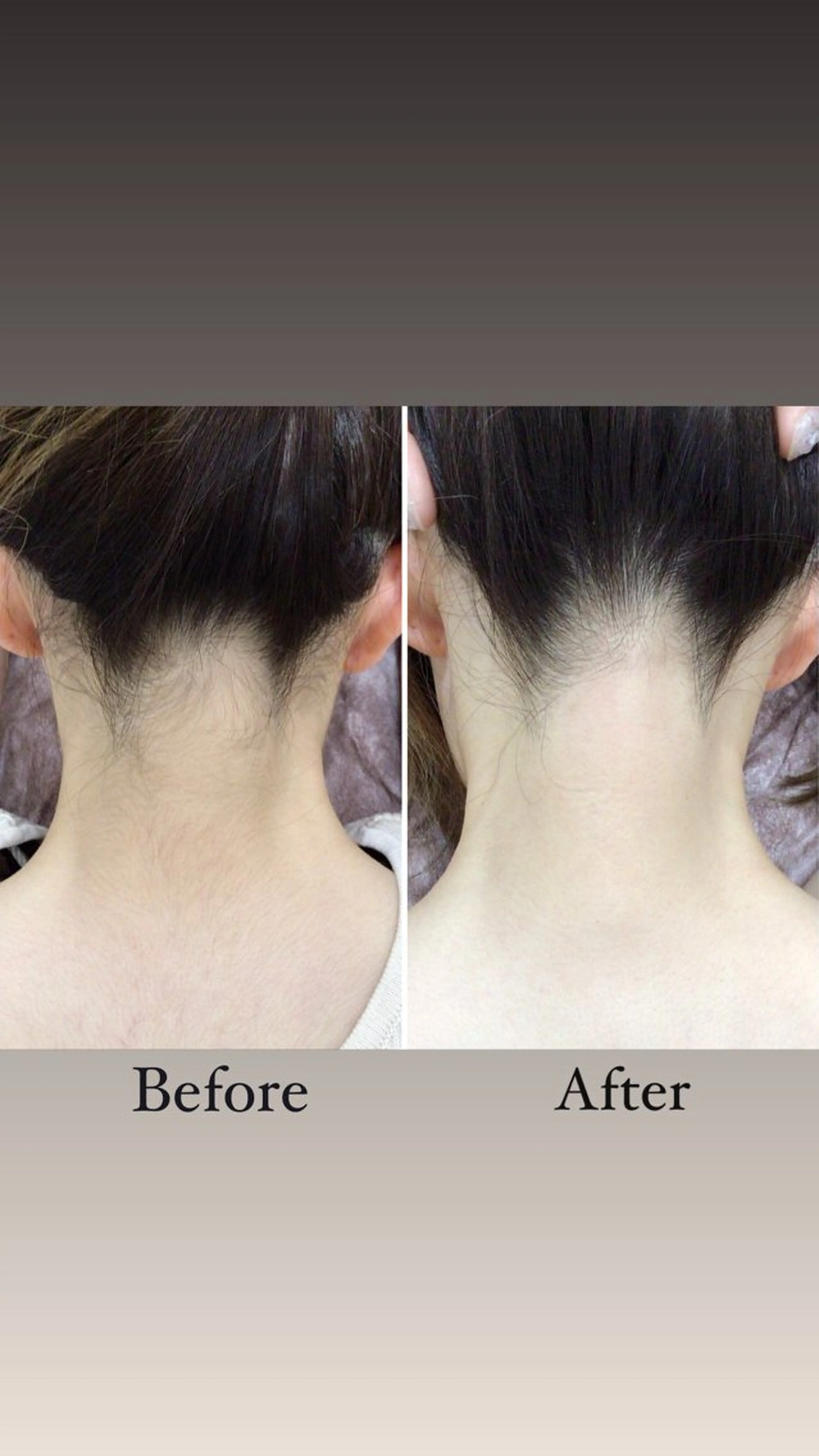 うなじ美肌脱毛💎の写真