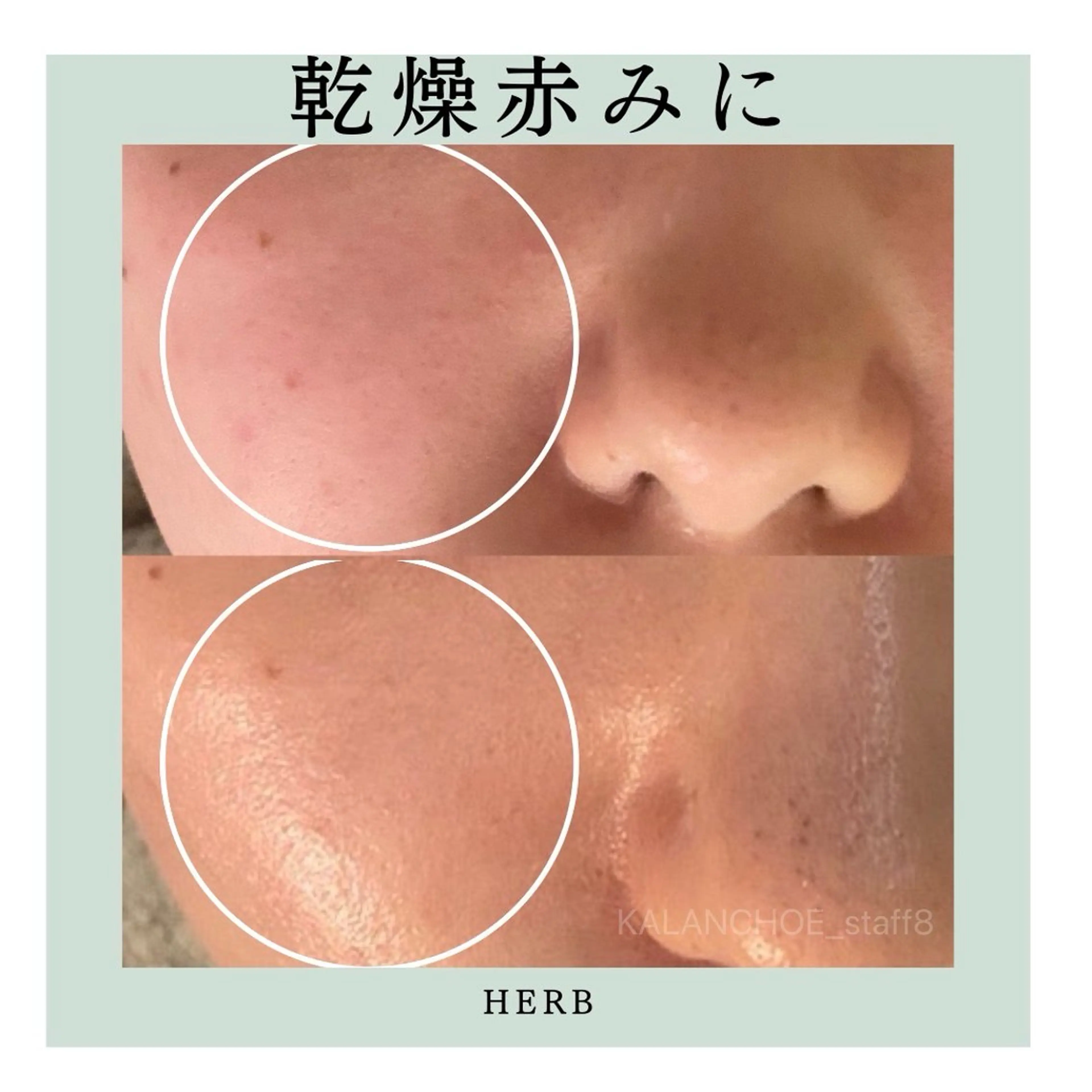 肌質改善 KALANCHOEのエステ・リラクイメージ