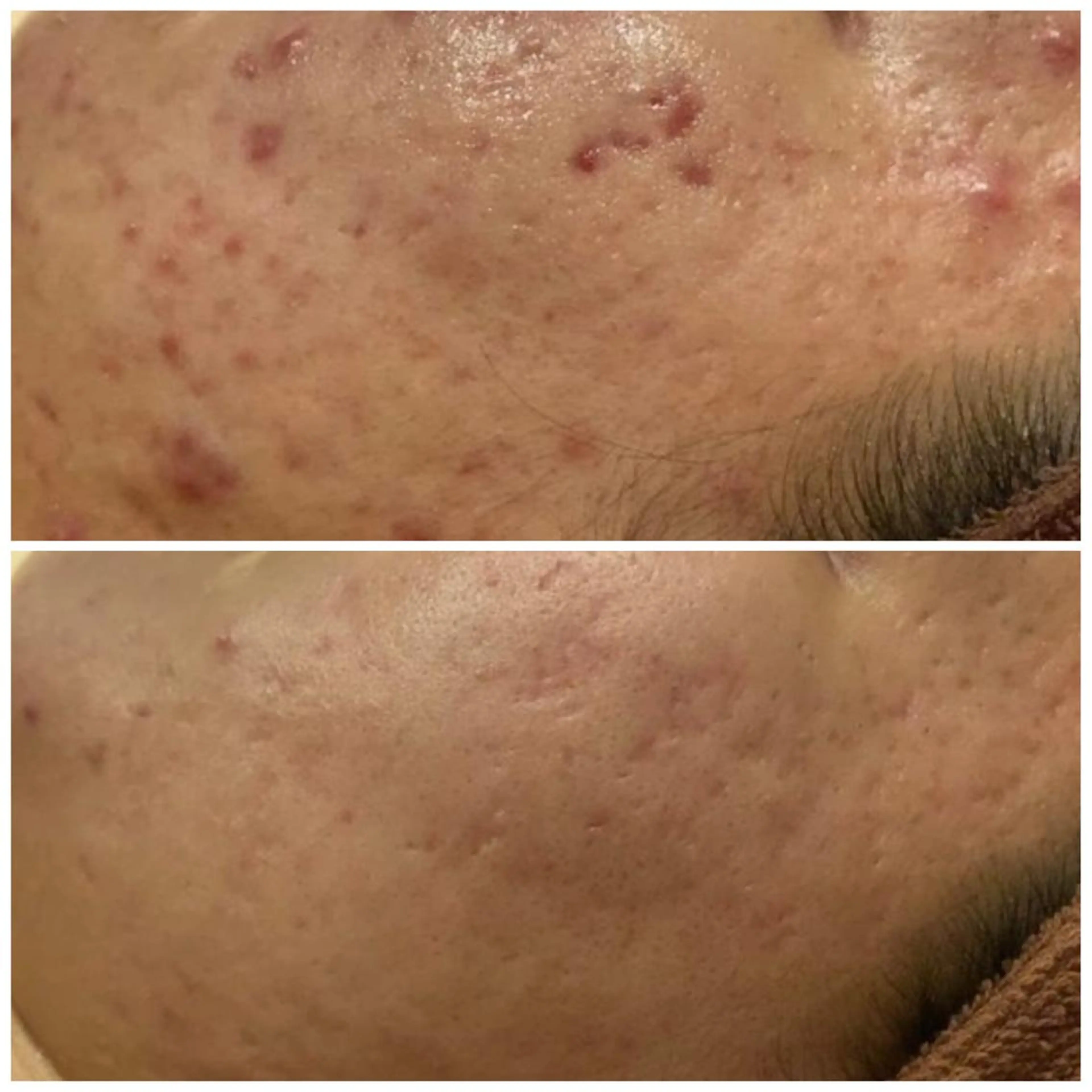 📍平日10-15時限定📍しつこいニキビ/繰り返すニキビ痕/毛穴/黒ずみ/天然温泉HOTパックつき♨️✨の写真