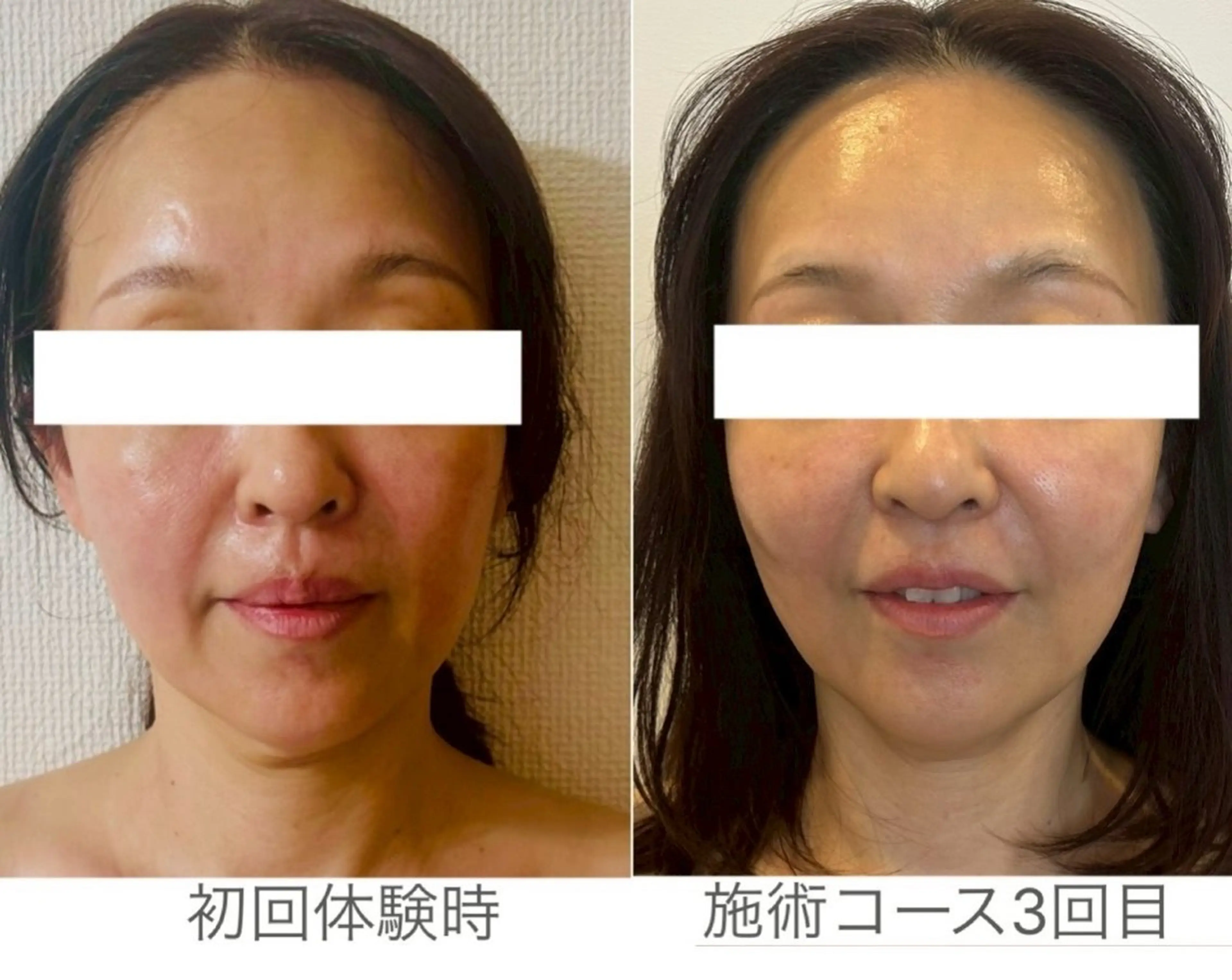 ブライダルプラン💍【 モニター 】トライアングルフェイシャル®️3回コース(高濃度酵素化粧品一式セット付き)の写真