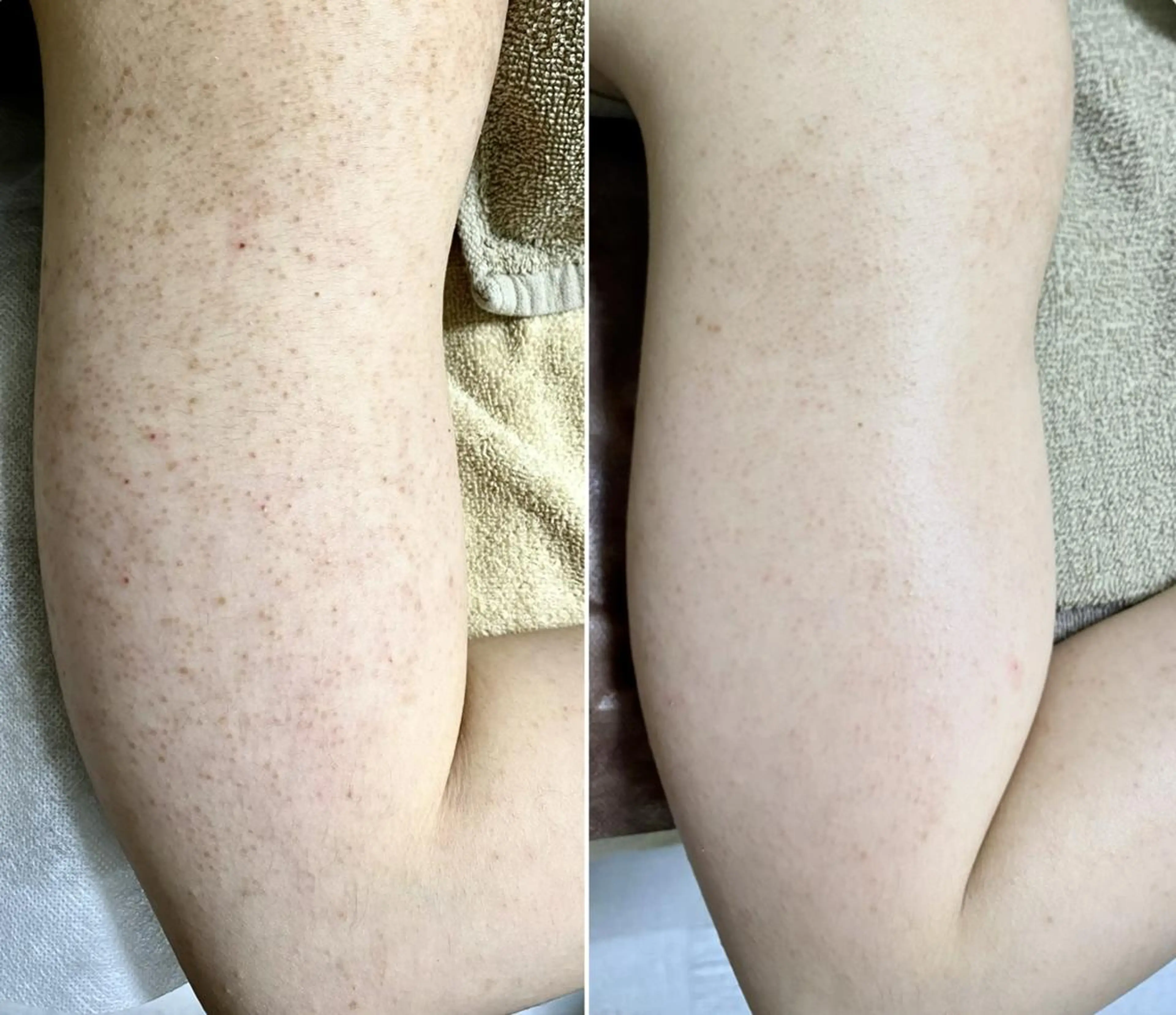 剥離ありハーブピーリング1部位 (背中上/背中下/二の腕/前腕/デコルテ)の写真