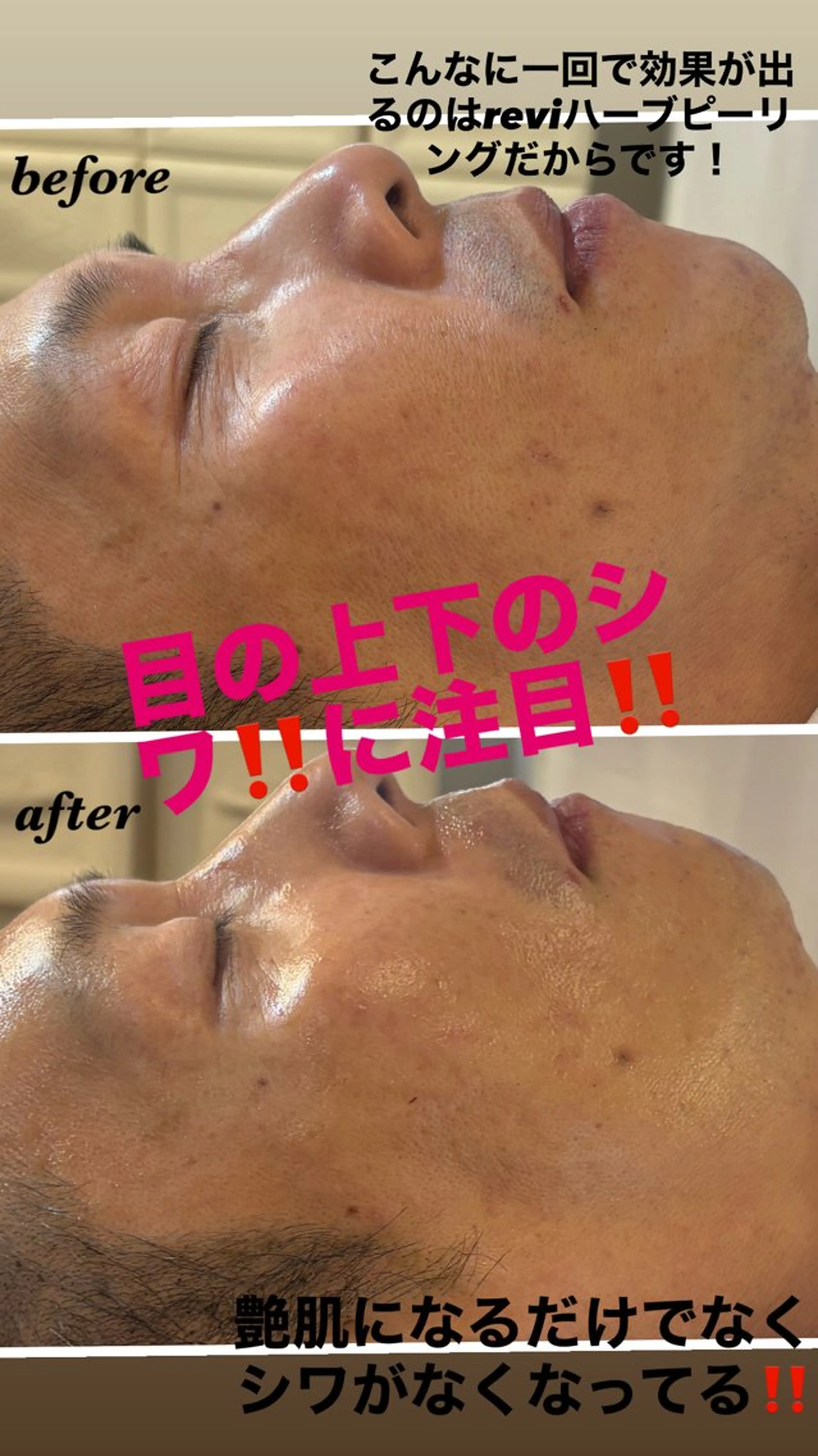 エステ ハーブピーリング専門 毛穴洗浄❤️眉waxのエステ・リラクイメージ