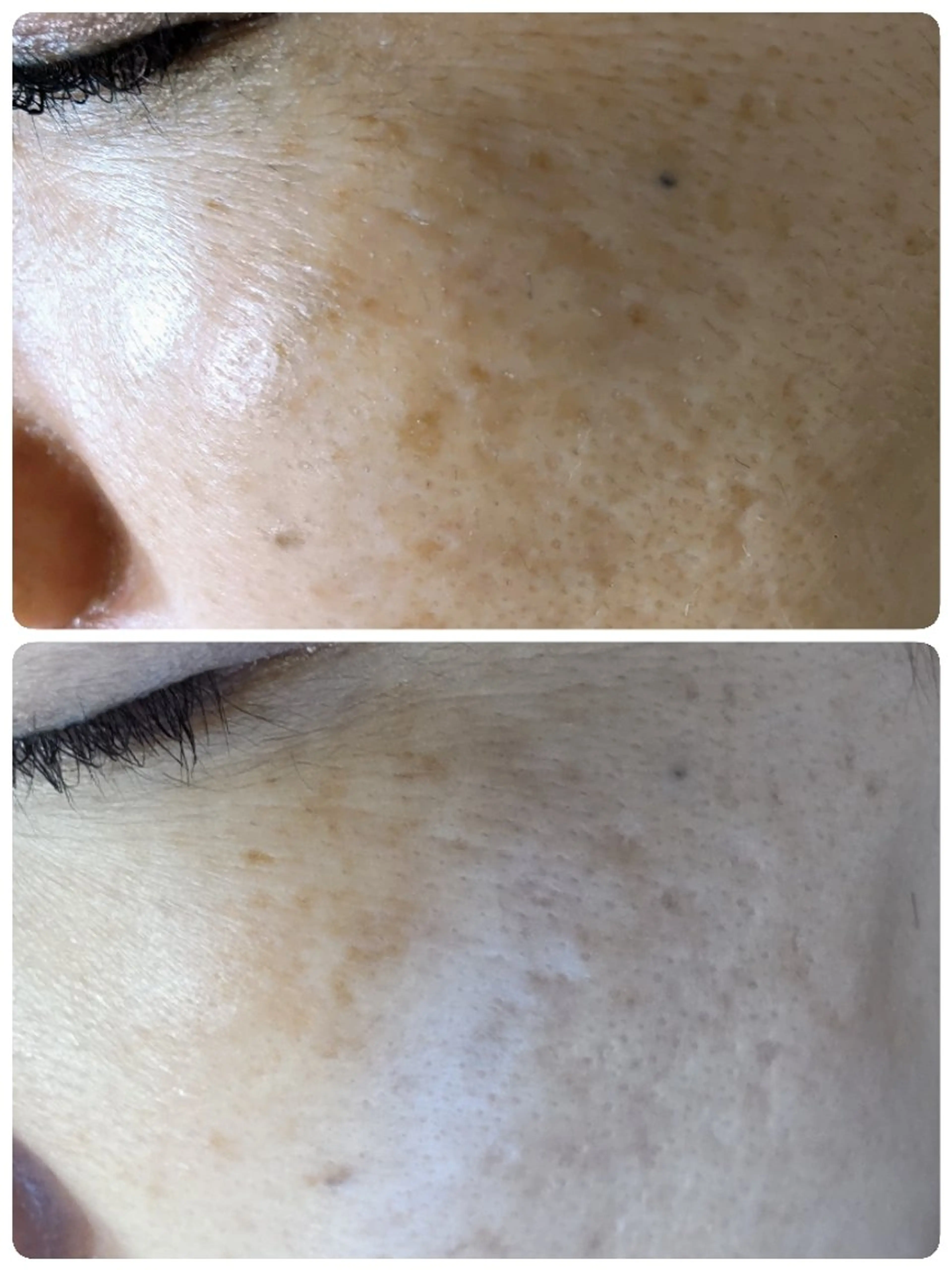 角質・毛穴洗浄🌼 脱毛🌸嶋津弘美のエステ・リラクイメージ