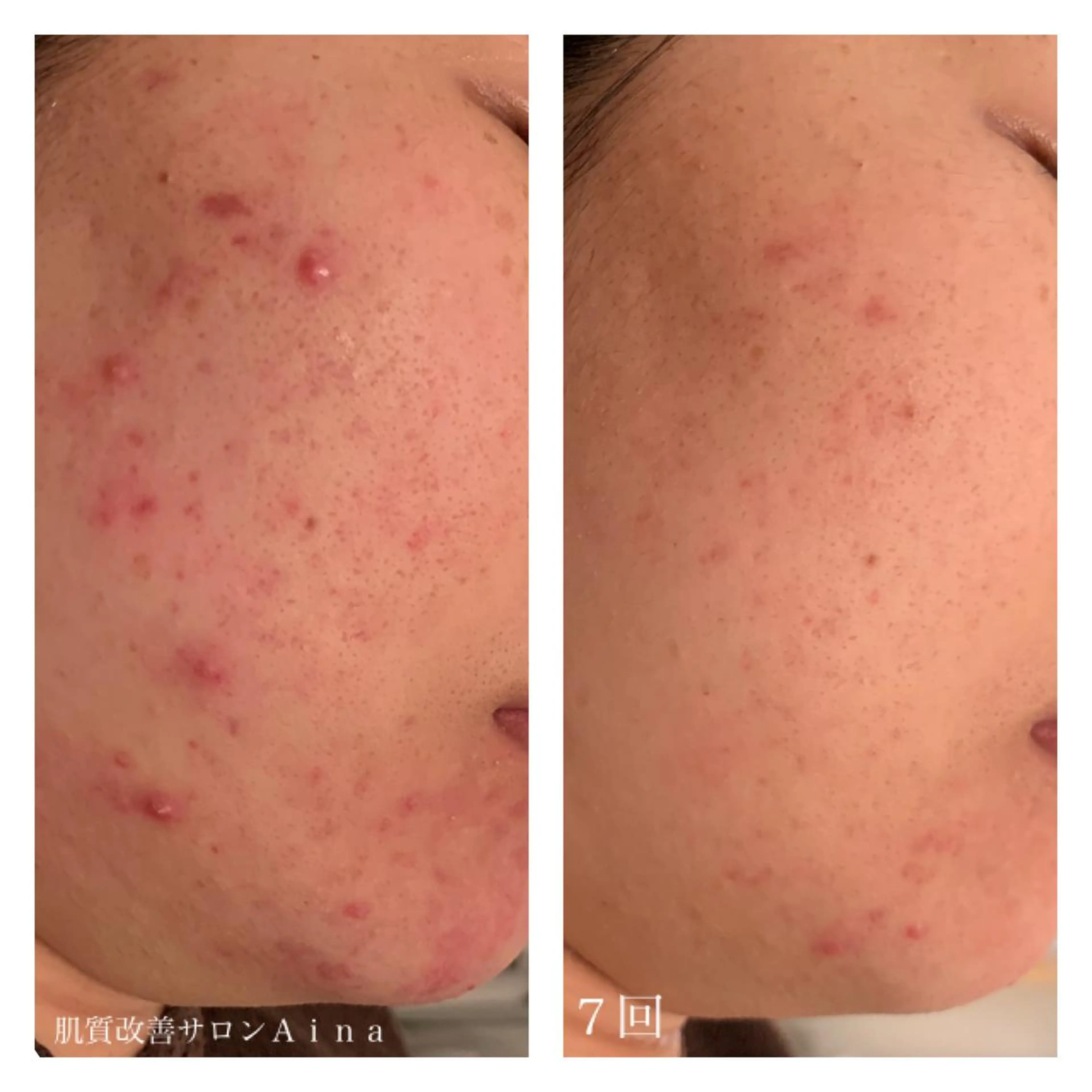 セミロング カラー パーマ ヘアアレンジ メンズ キッズ ネイル マツエク・マツパ 卒業式のヘアスタイル 卒業式 エステ リラク ニキビ跡専門サロン Ａｉｎａのエステ・リラクイメージ