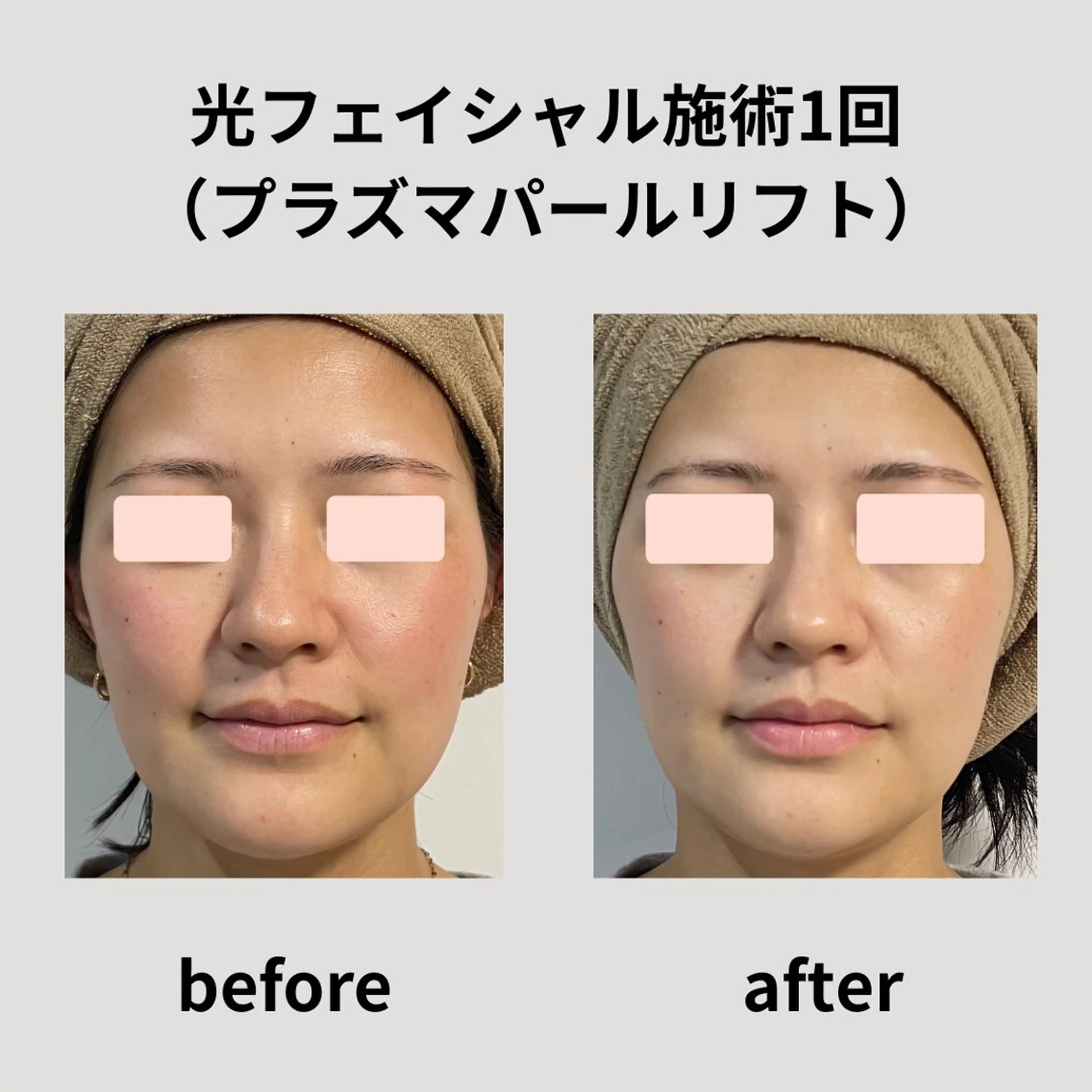 脱毛 脱毛＆フェイシャル H'euriaのエステ・リラクイメージ