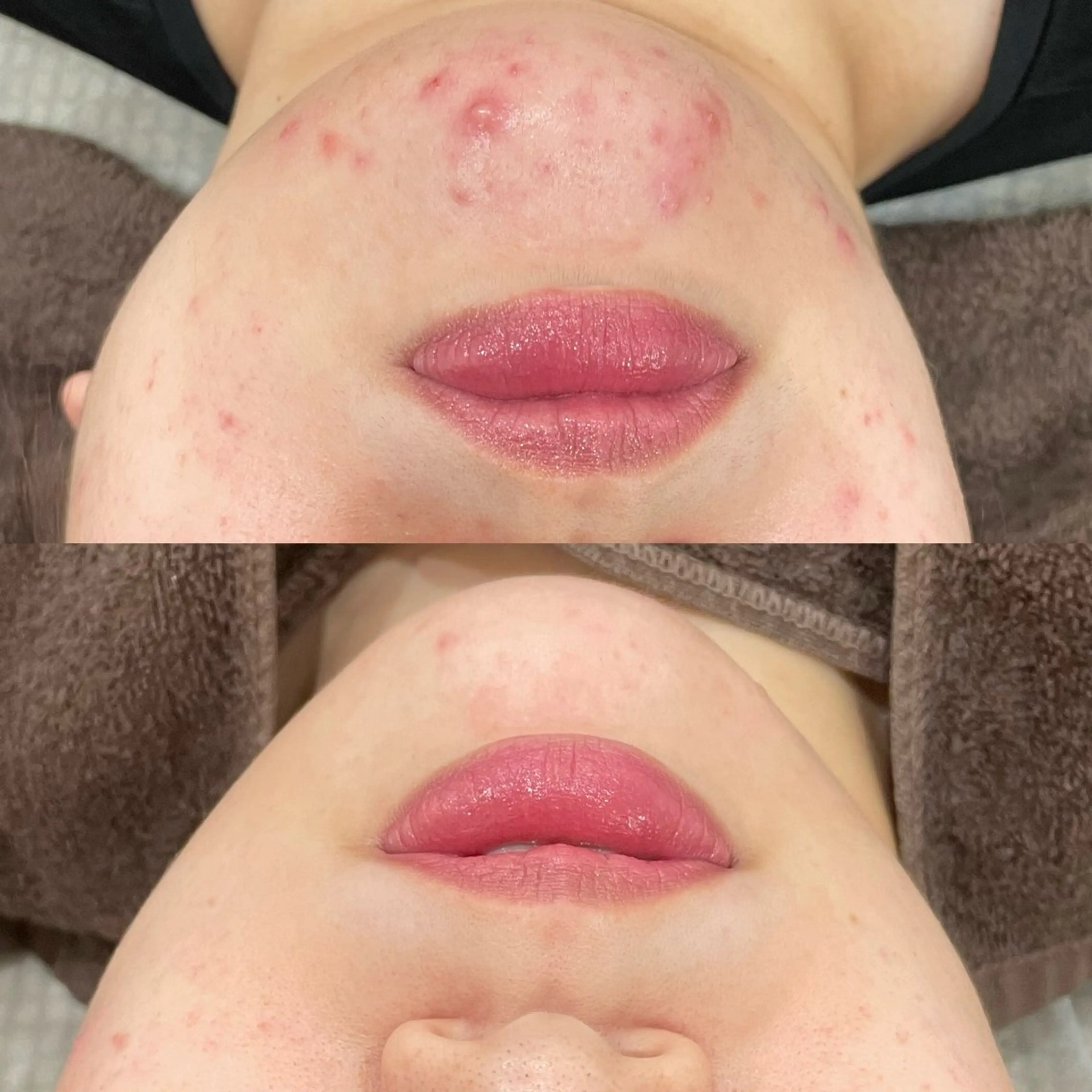 【平日のみ】背中剥離ありハーブピーリング🌿の写真