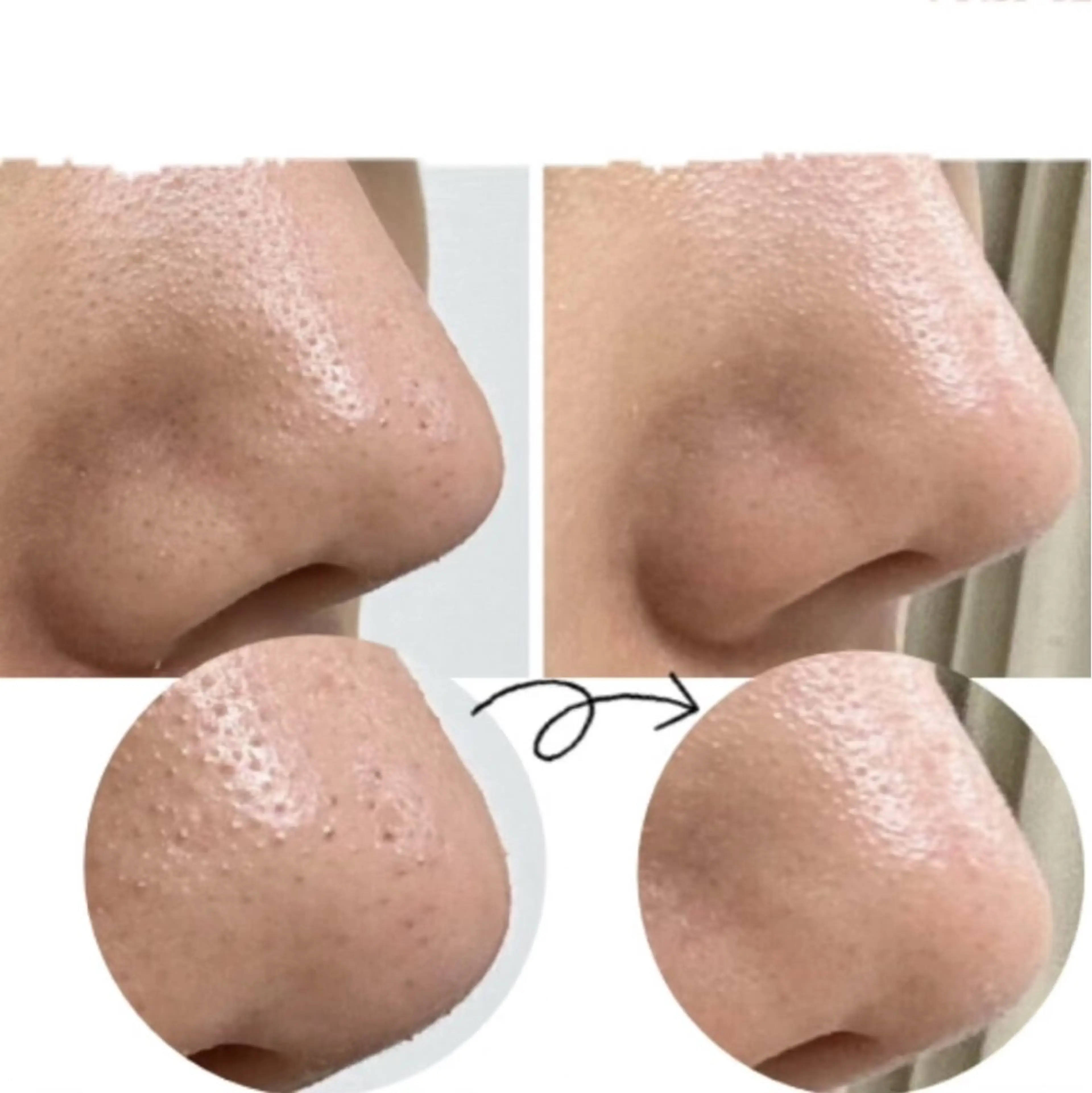 【毛穴ケア/角栓洗浄/いちご鼻】毛穴エクストラクション ¥8200→¥4900の写真