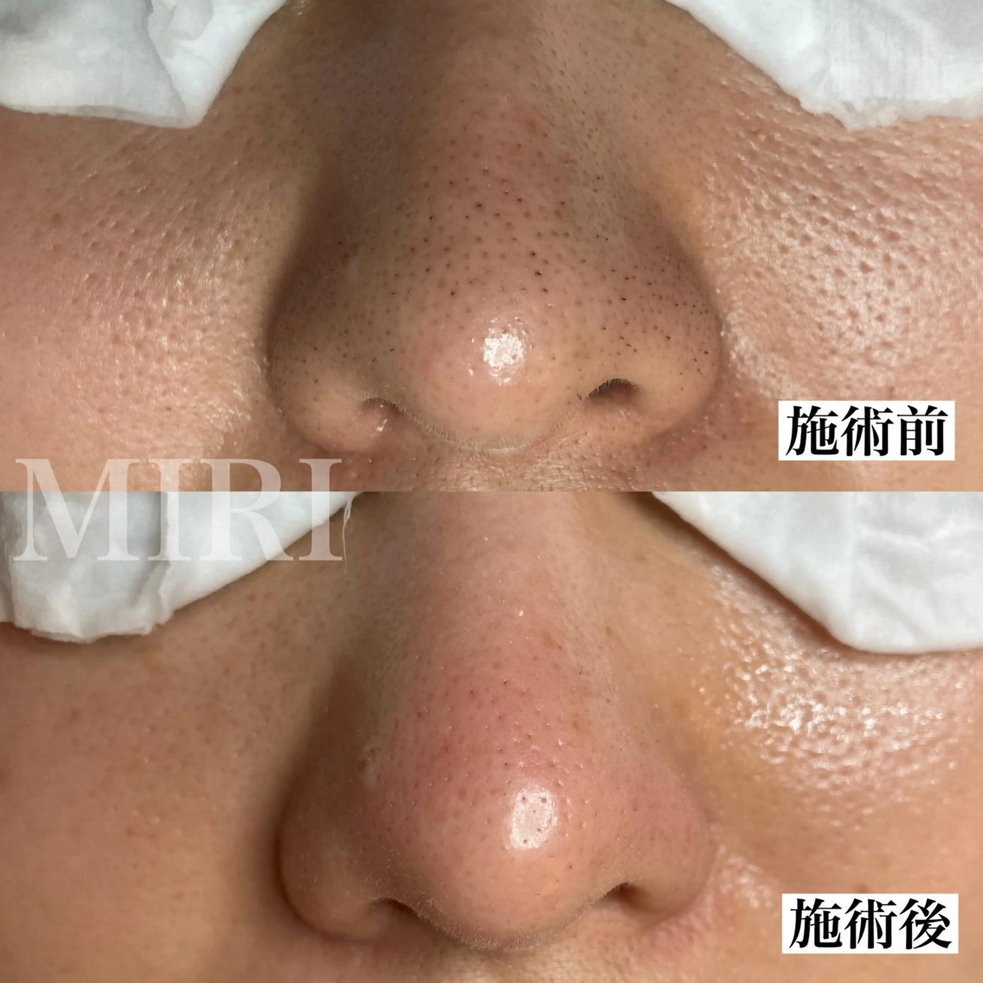 【29歳以下の方限定】いちご鼻バイバイ🍓ツルツル美肌になる毛穴ケア50分【ミニモ特別価格】カウンセリング込み80分の写真