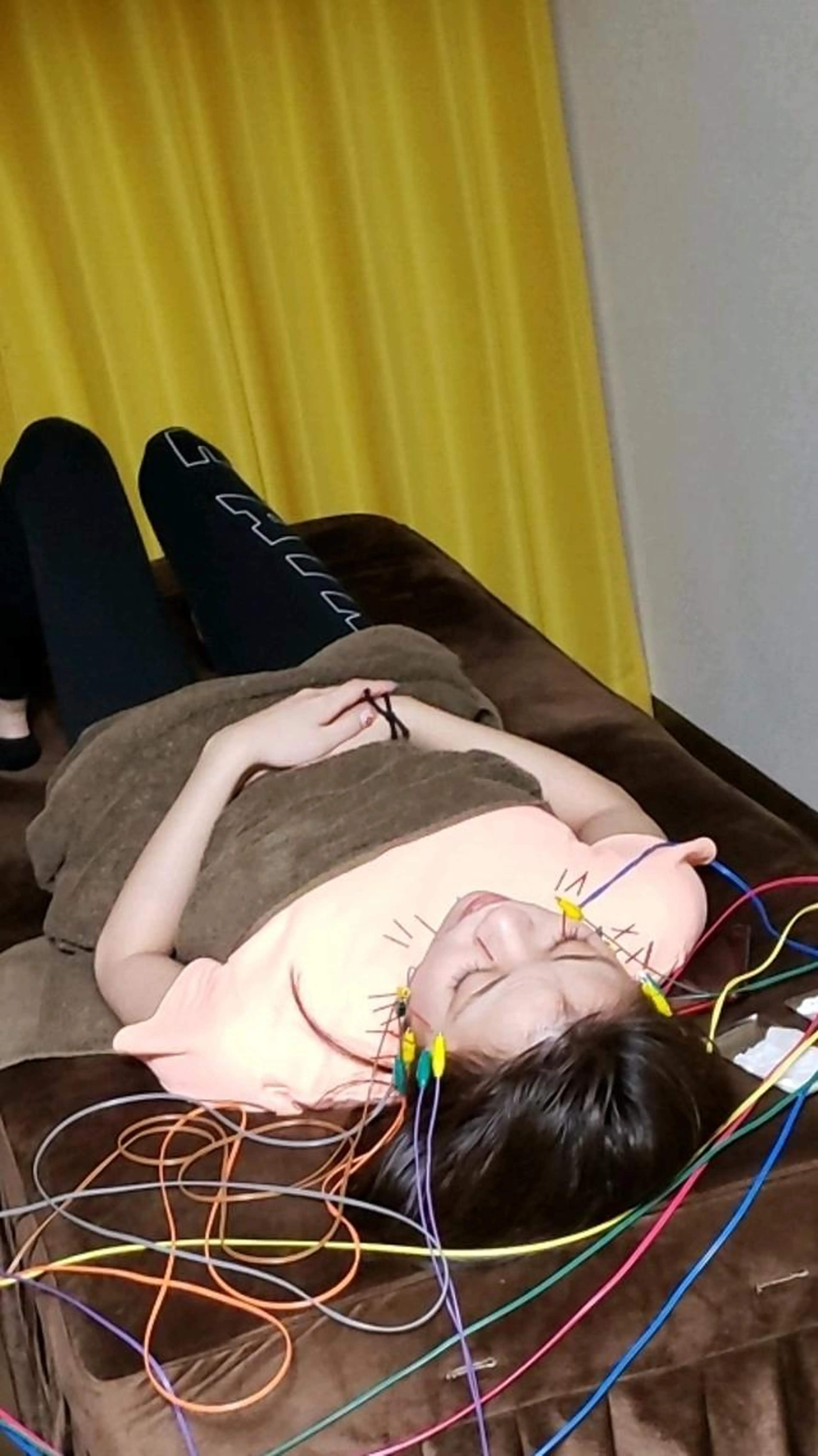 美容鍼30本+パルス8本+小顔矯正　60分の写真