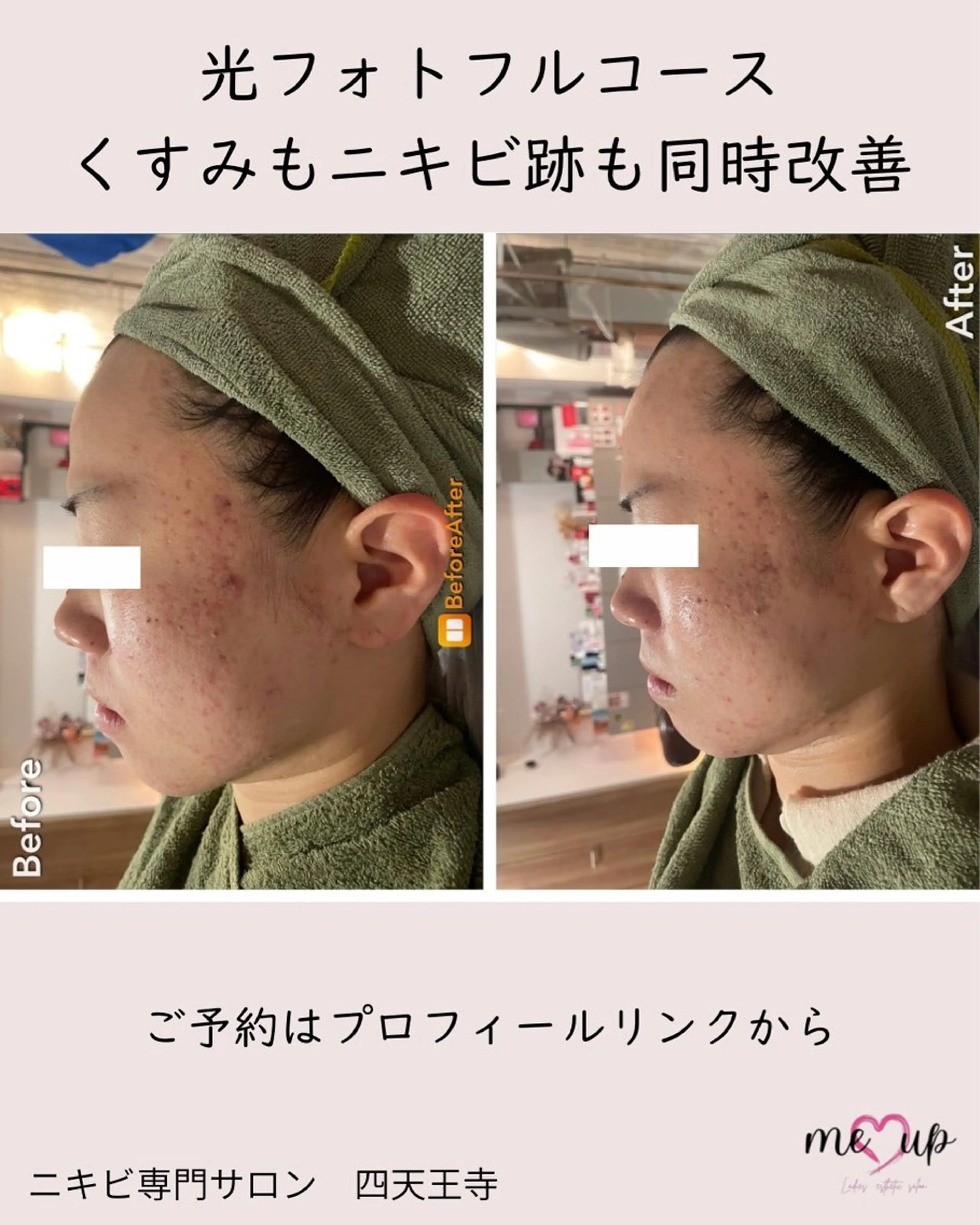 エステ Meupニキビ専門店 背中/ハーブ/肌管理のその他イメージ