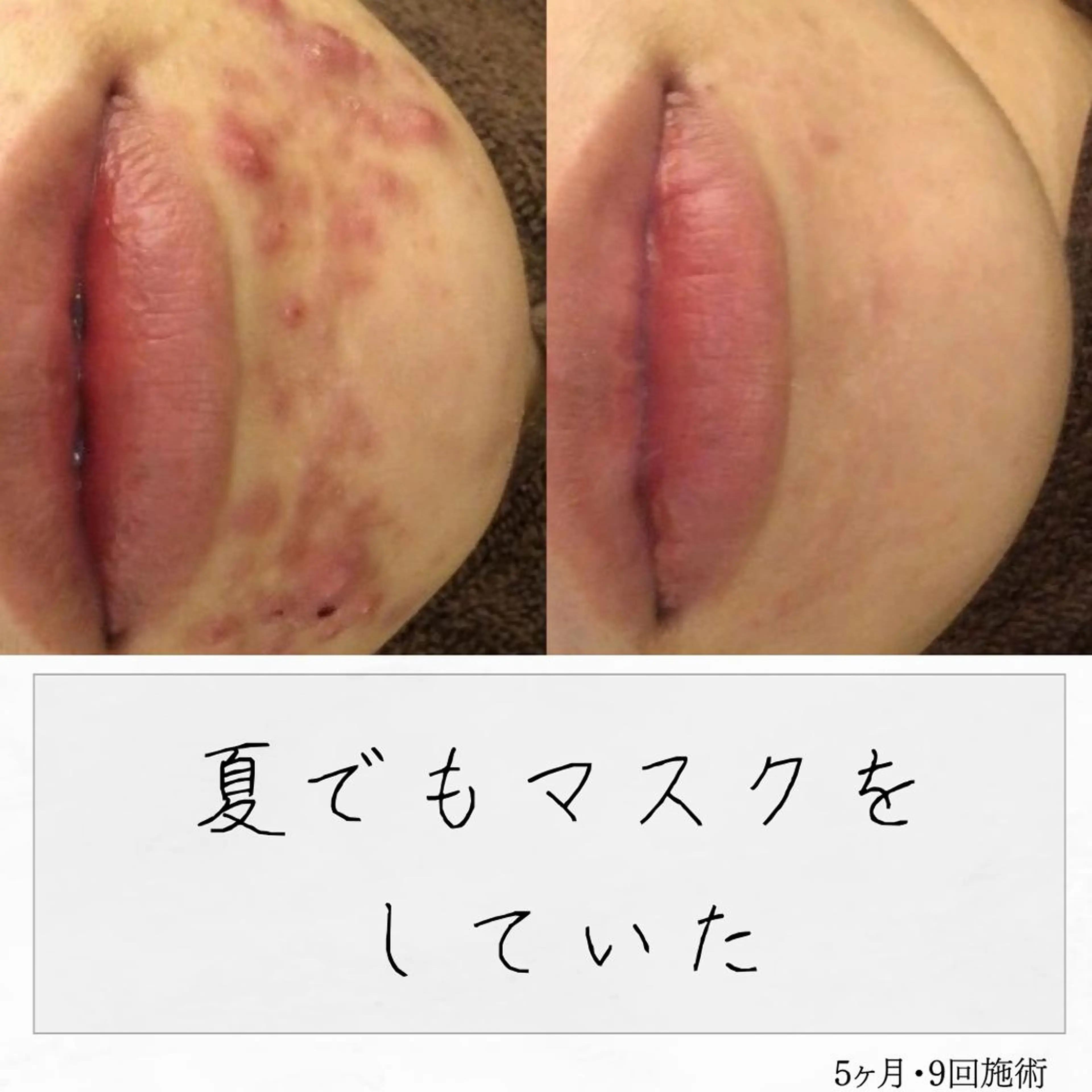 ニキビ経験者が施術 する専門サロン🌻のエステ・リラクイメージ