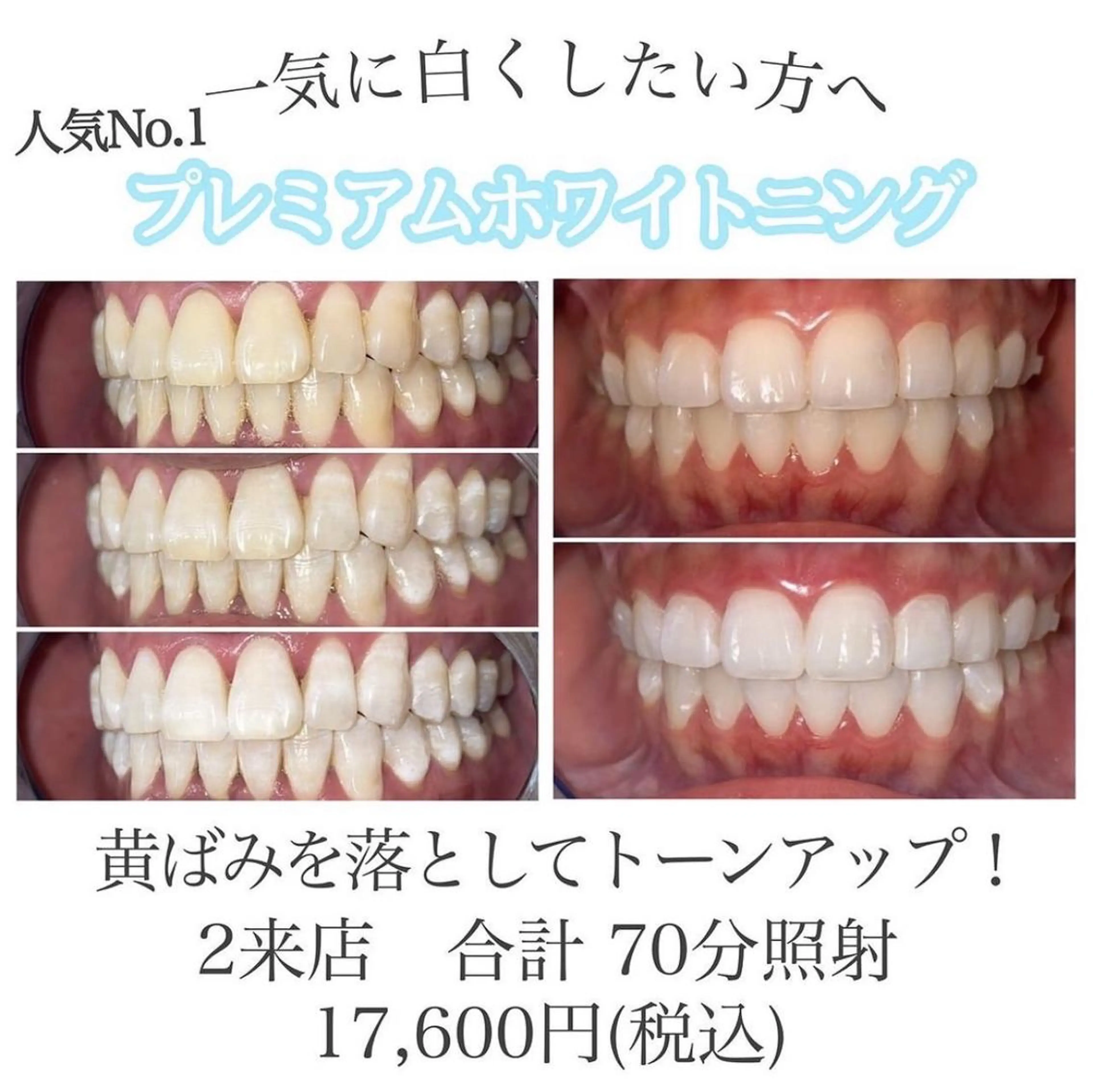 【人気No.１】プレミアムホワイトニング 2来店合計70分 輝く白い歯へ🦷✨の写真