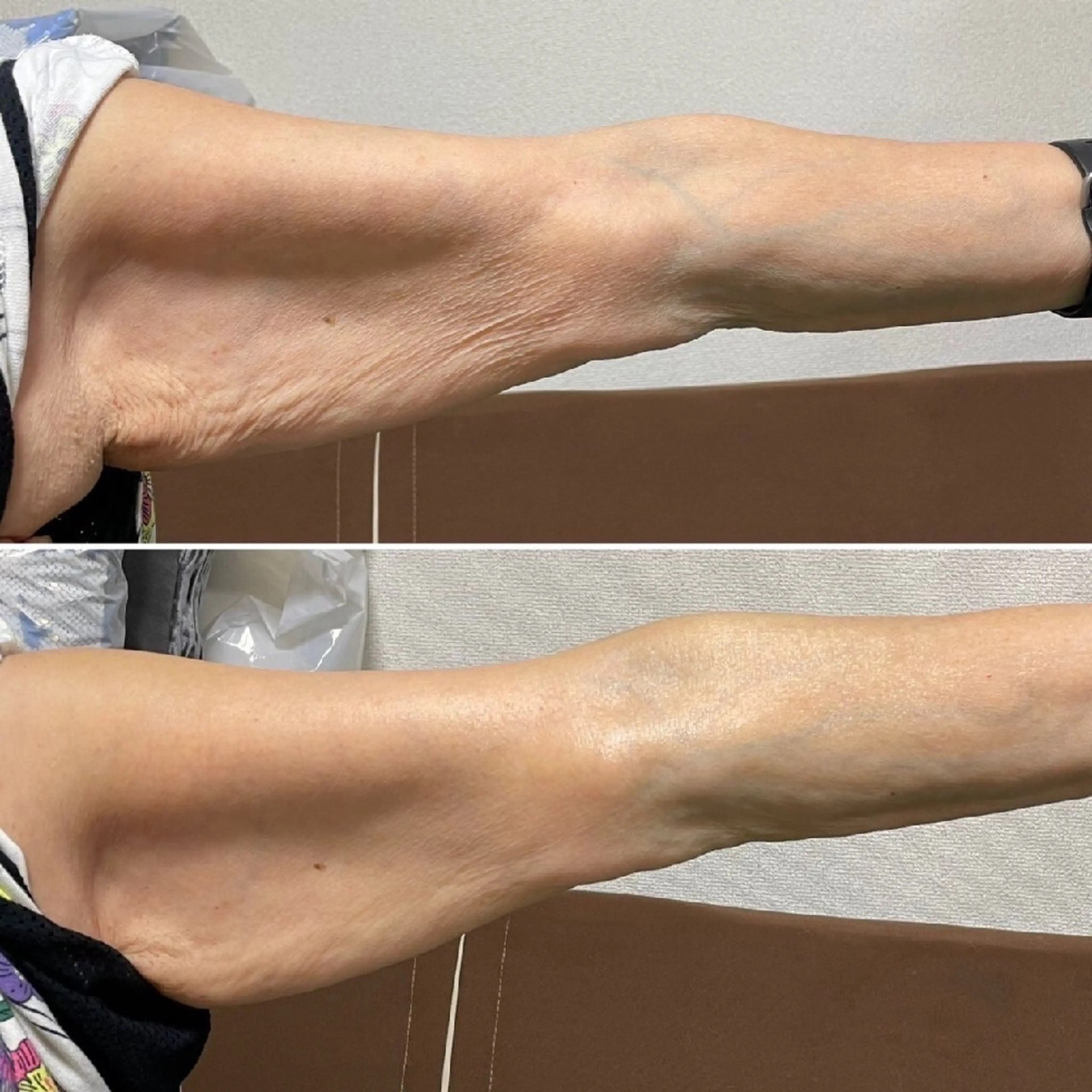 腕or足の痩身エステコースの写真