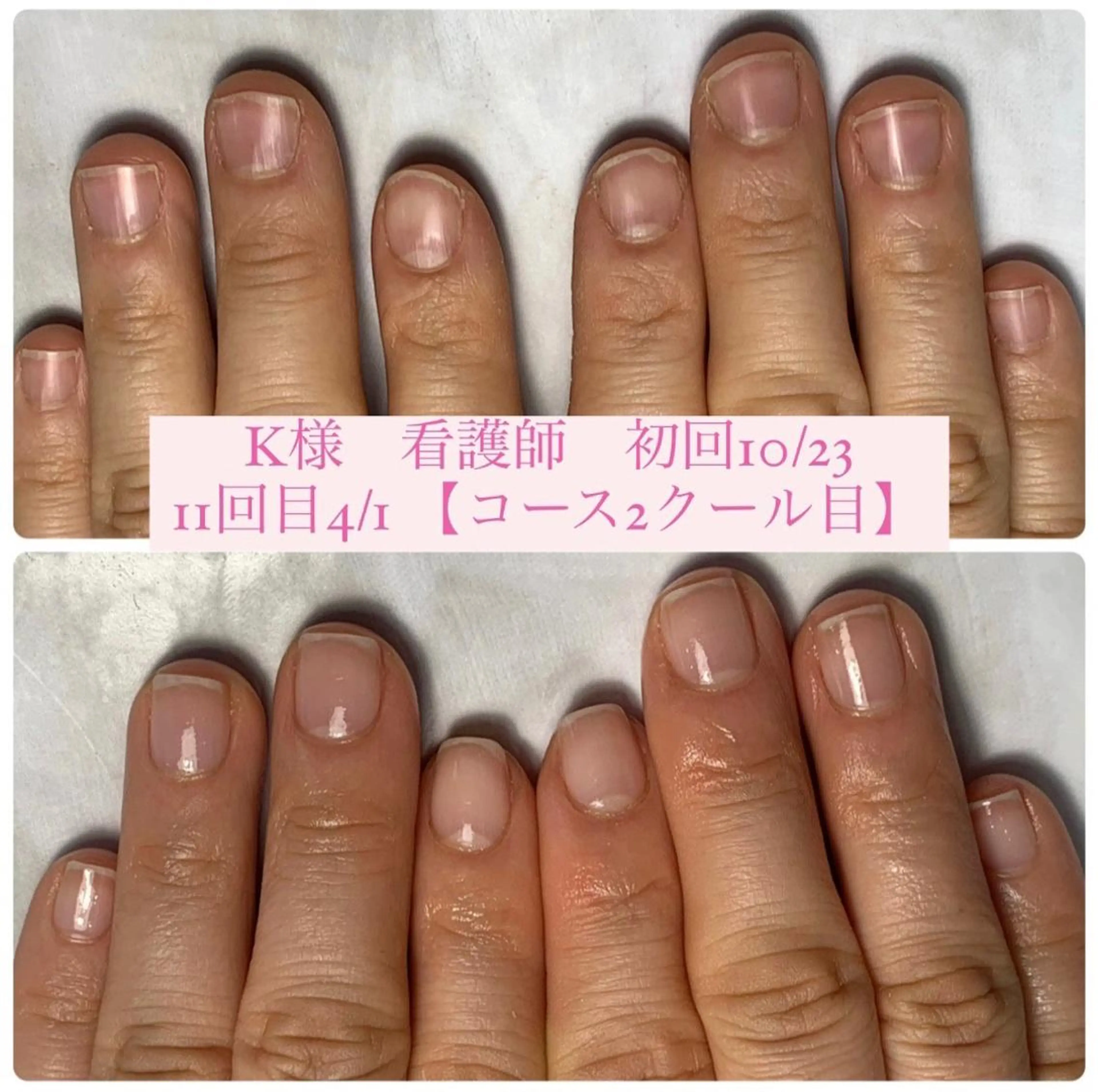 ネイル 自爪育成/深爪矯正 mikiのネイルデザイン