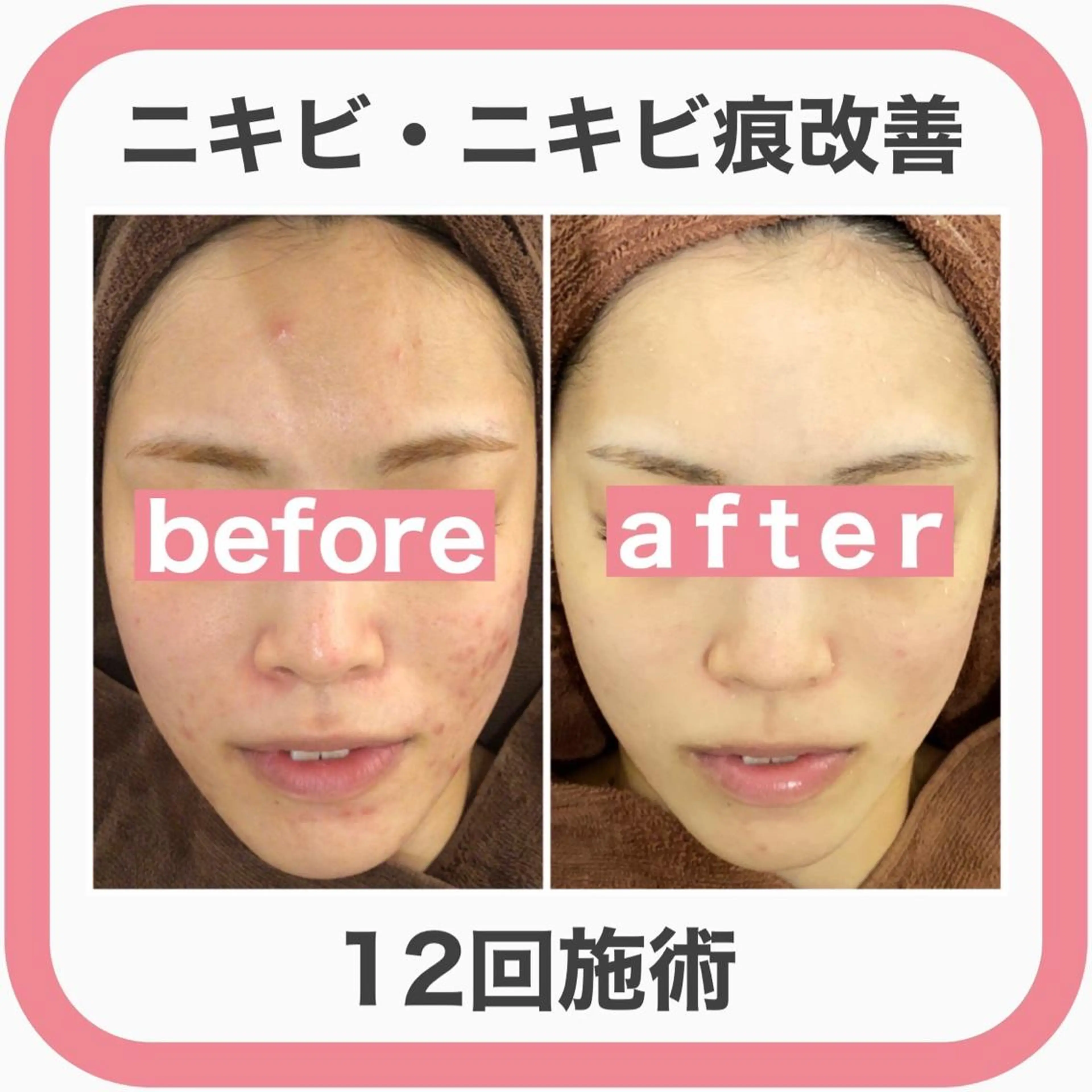 セミロング カラー パーマ ヘアアレンジ メンズ キッズ ネイル マツエク・マツパ アイブロウ エステ リラク 3か月で肌革命👼 ニキビ専門店💫のエステ・リラクイメージ