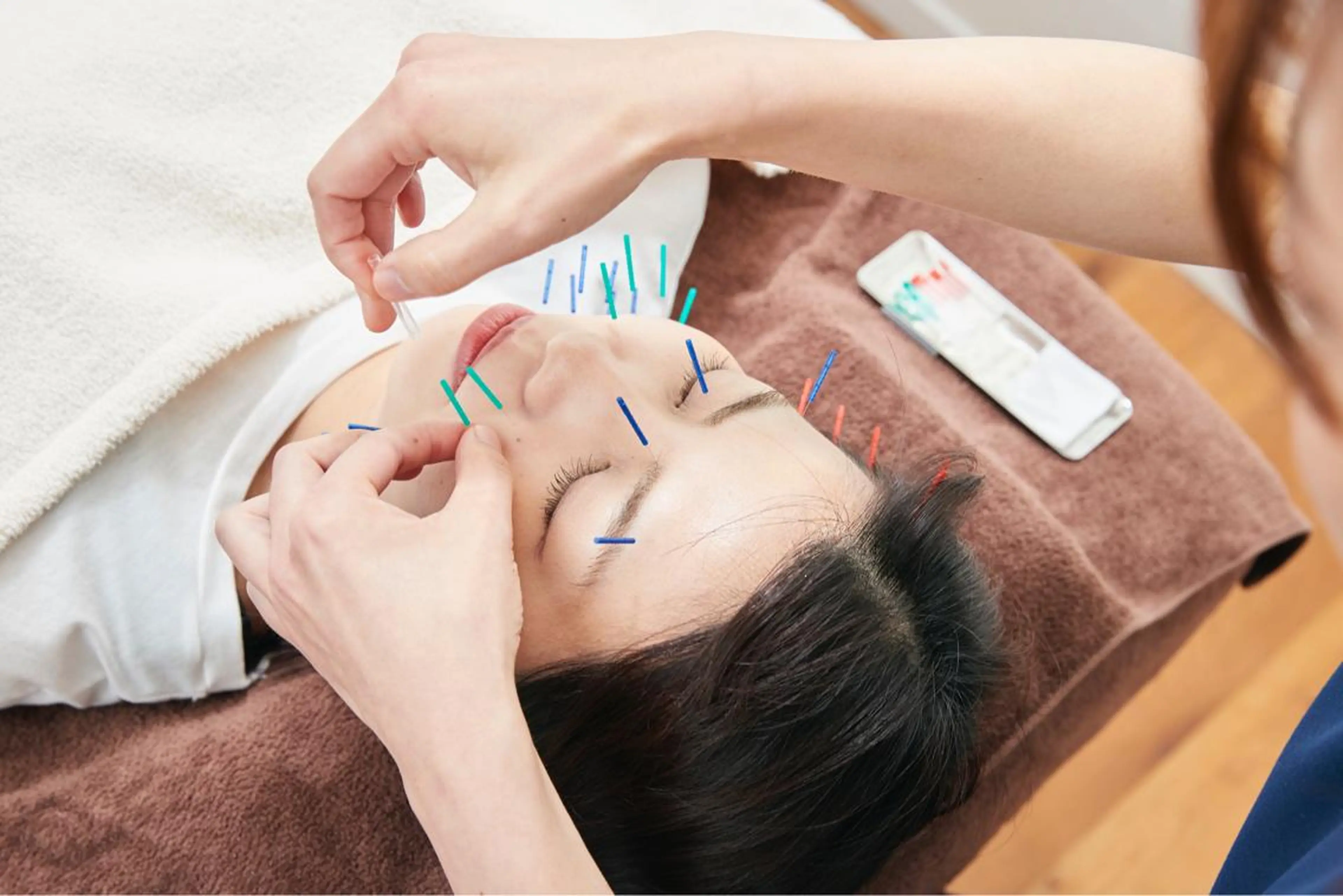 【 美容鍼 】(エイジングケア・肌トラブルに)鍼60本程🪡の写真