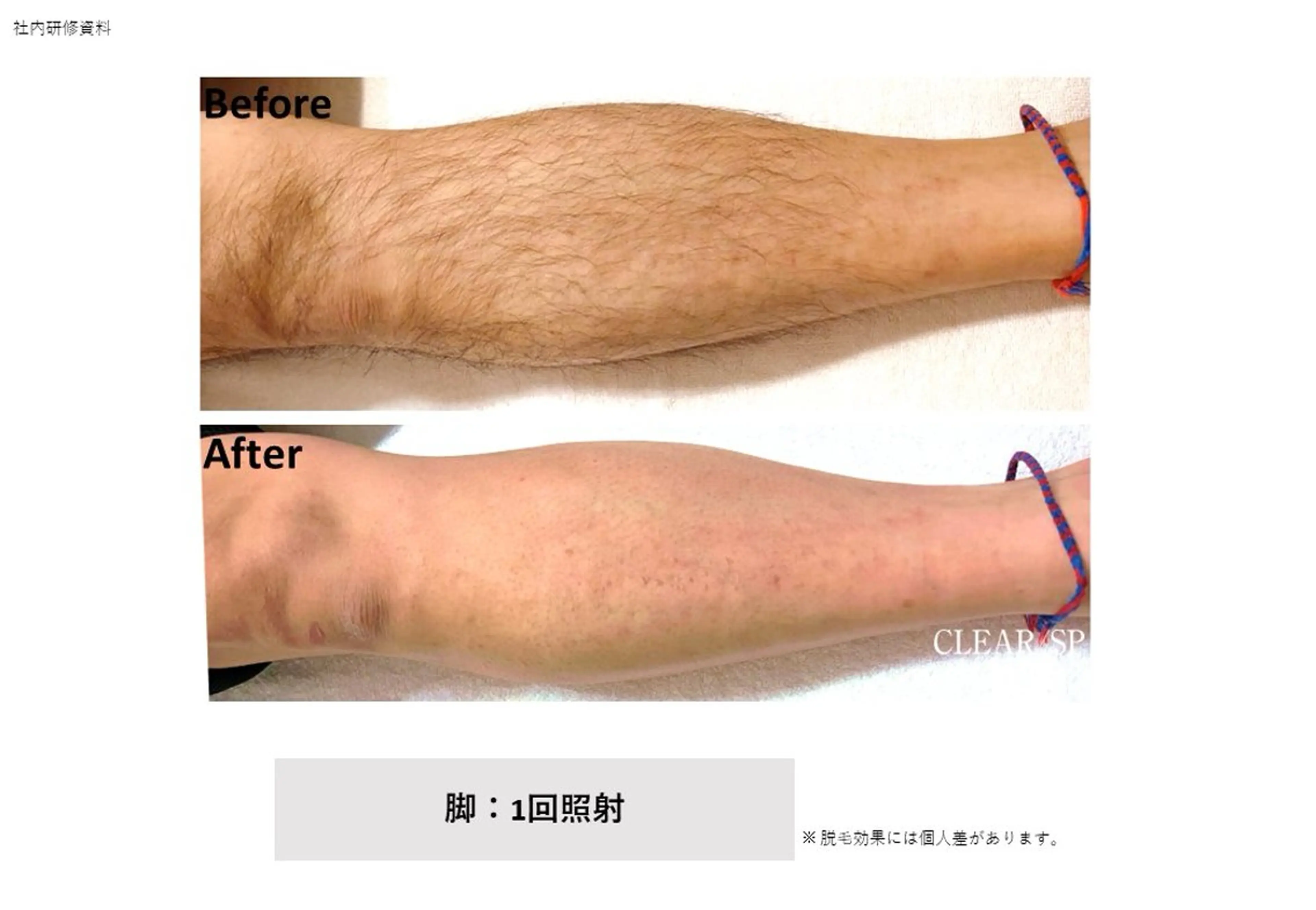 メンズ 脱毛 Yuna ⟡.·*.のネイルデザイン