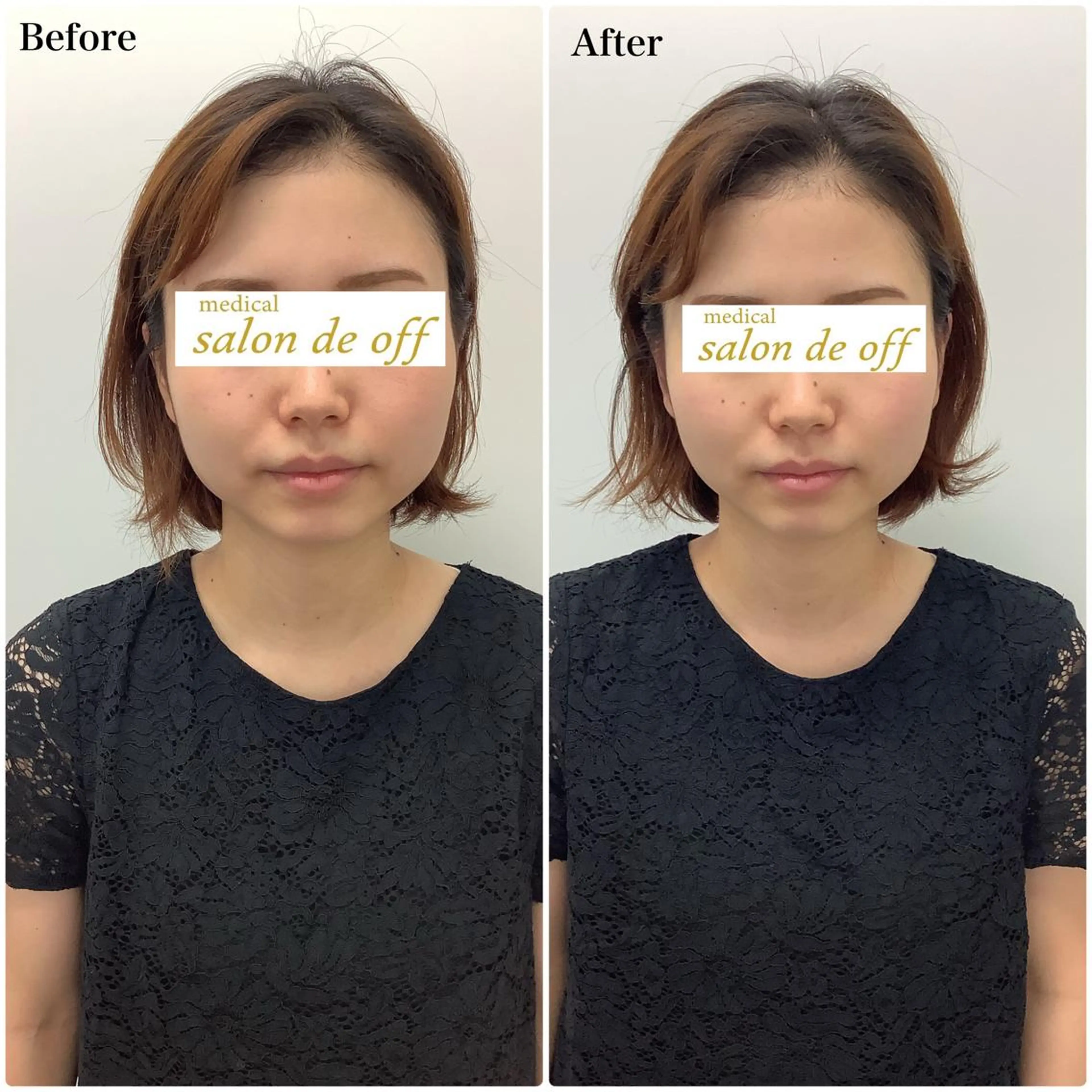 【🌷初回限定🌷】小顔矯正+ドライヘッドス+美骨整体(60分)の写真