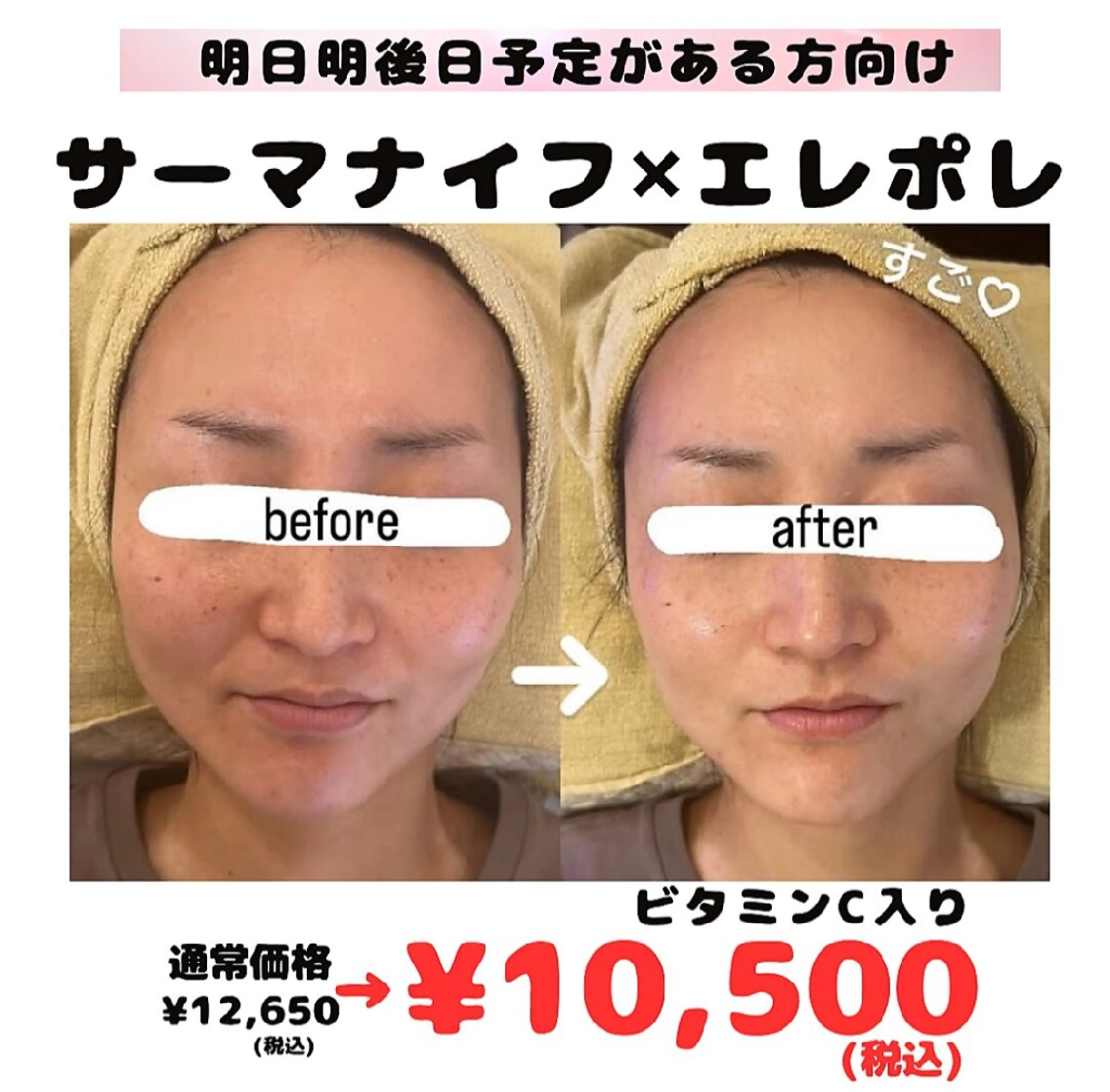 【即効性美肌コース】サーマ×エレポレ 通常¥12,650→¥10,500【ビタミンin】の写真