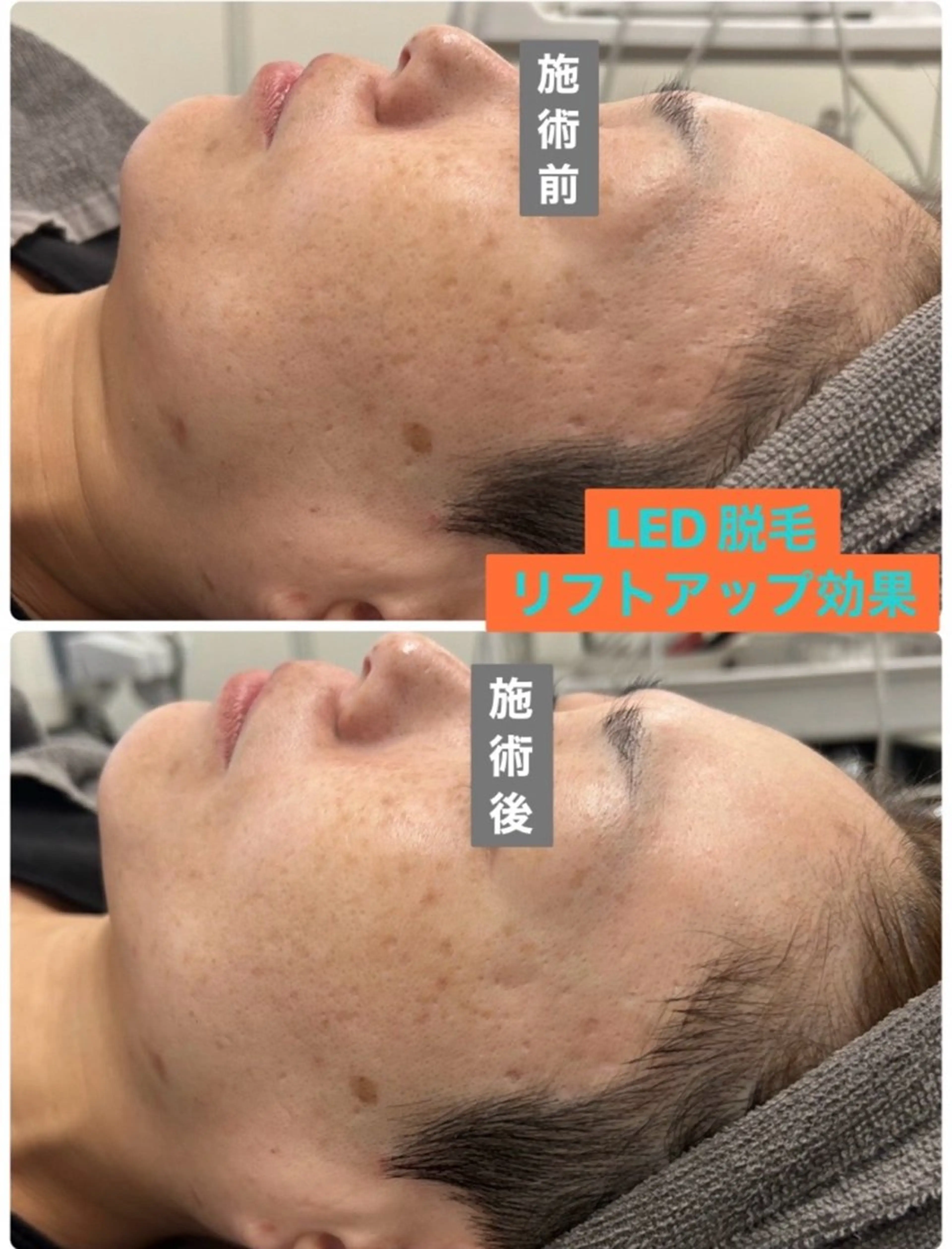 学生限定❗️美肌になれちゃう⚡️LED脱毛⚡️全身(VIOor顔)     男女🆗《口コミ投稿込み》の写真