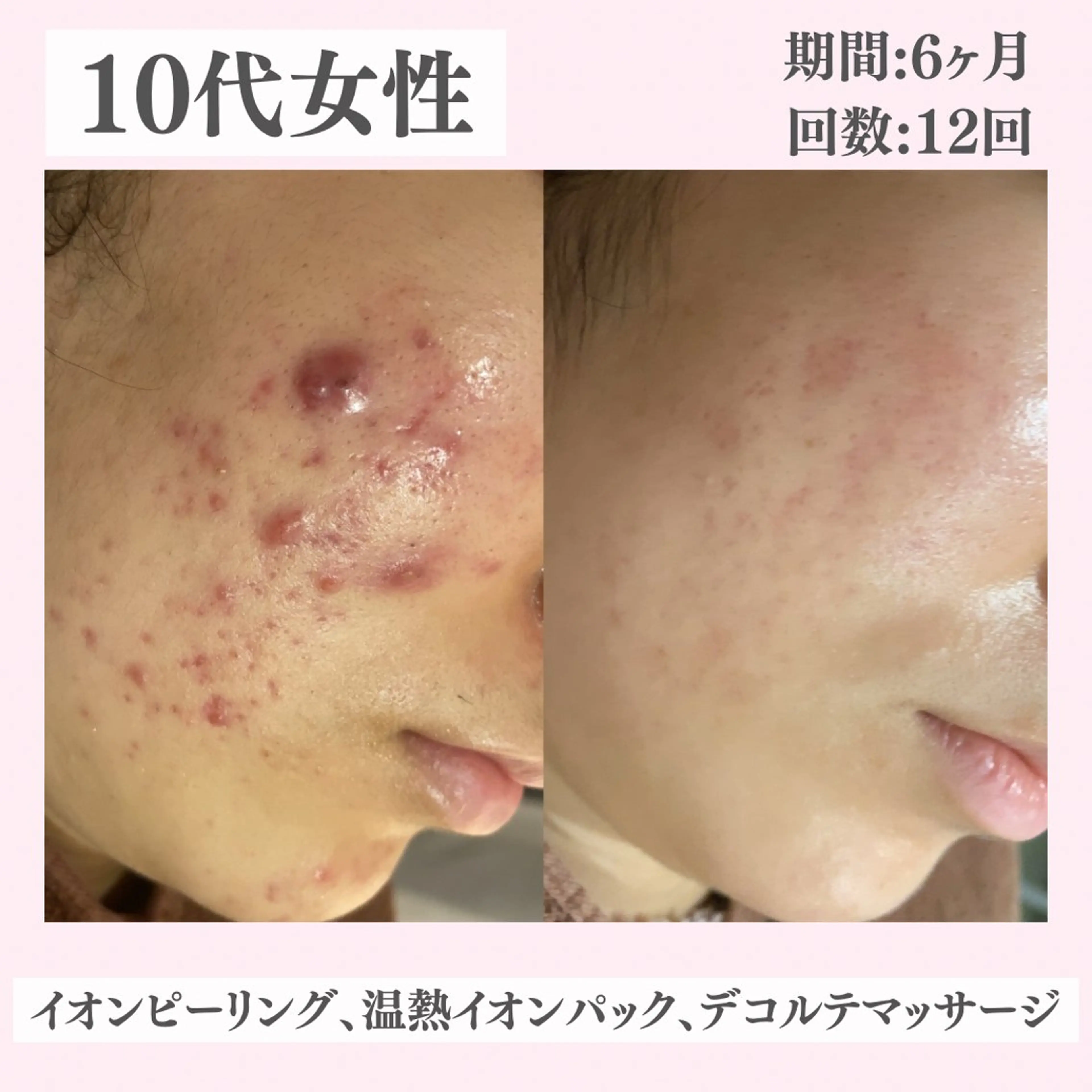 エステ リラク ニキビ・肌質改善専門 ♡人生が変わるサロンのエステ・リラクイメージ