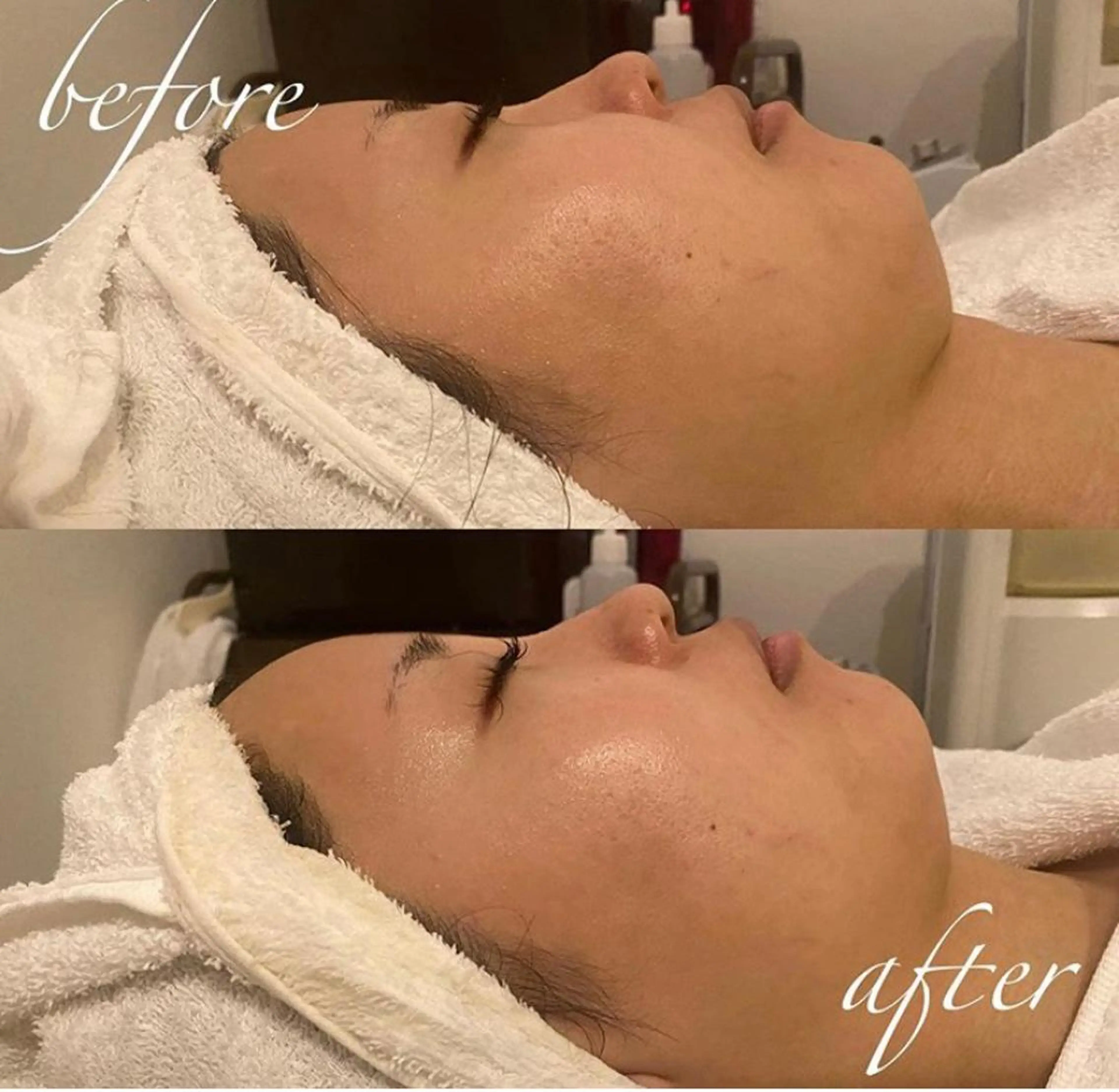 エステ 韓国/ピーリング 毛穴洗浄/POLAのエステ・リラクイメージ