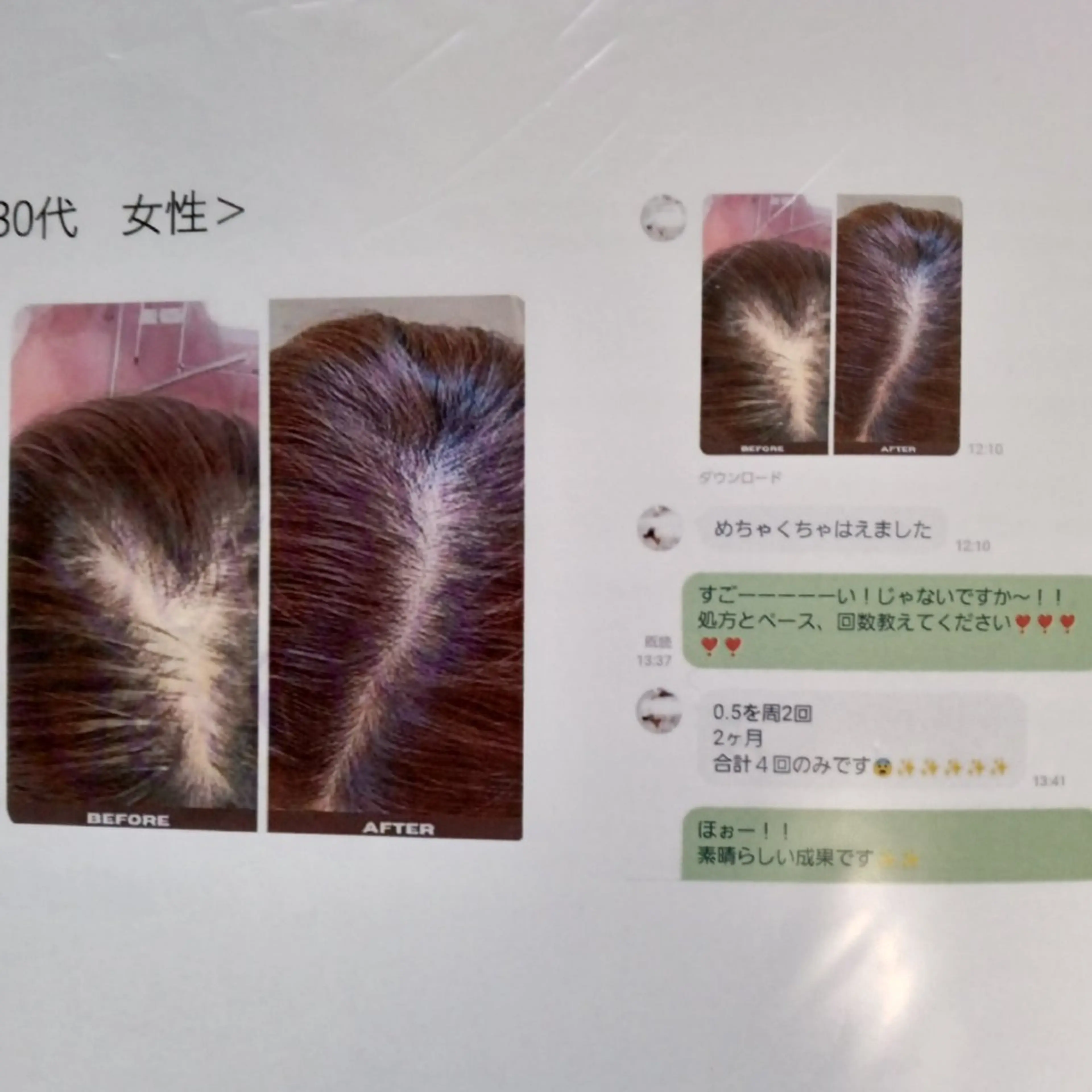 【薄毛・細毛・健康頭皮へ】頭皮ケア　スカルプ棘ケア3回コースの写真