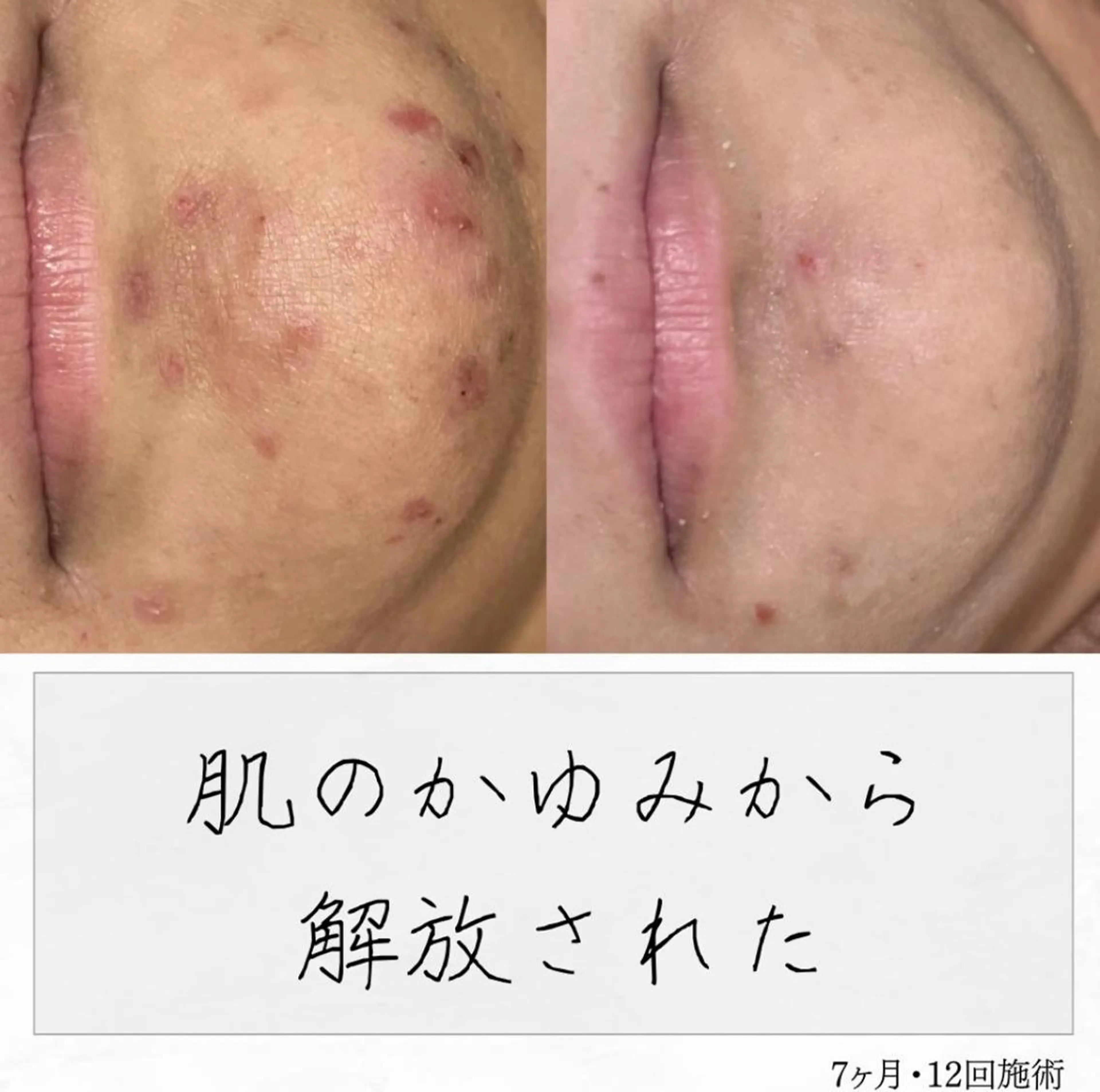 ニキビ経験者が施術 する専門サロン🌻のエステ・リラクイメージ