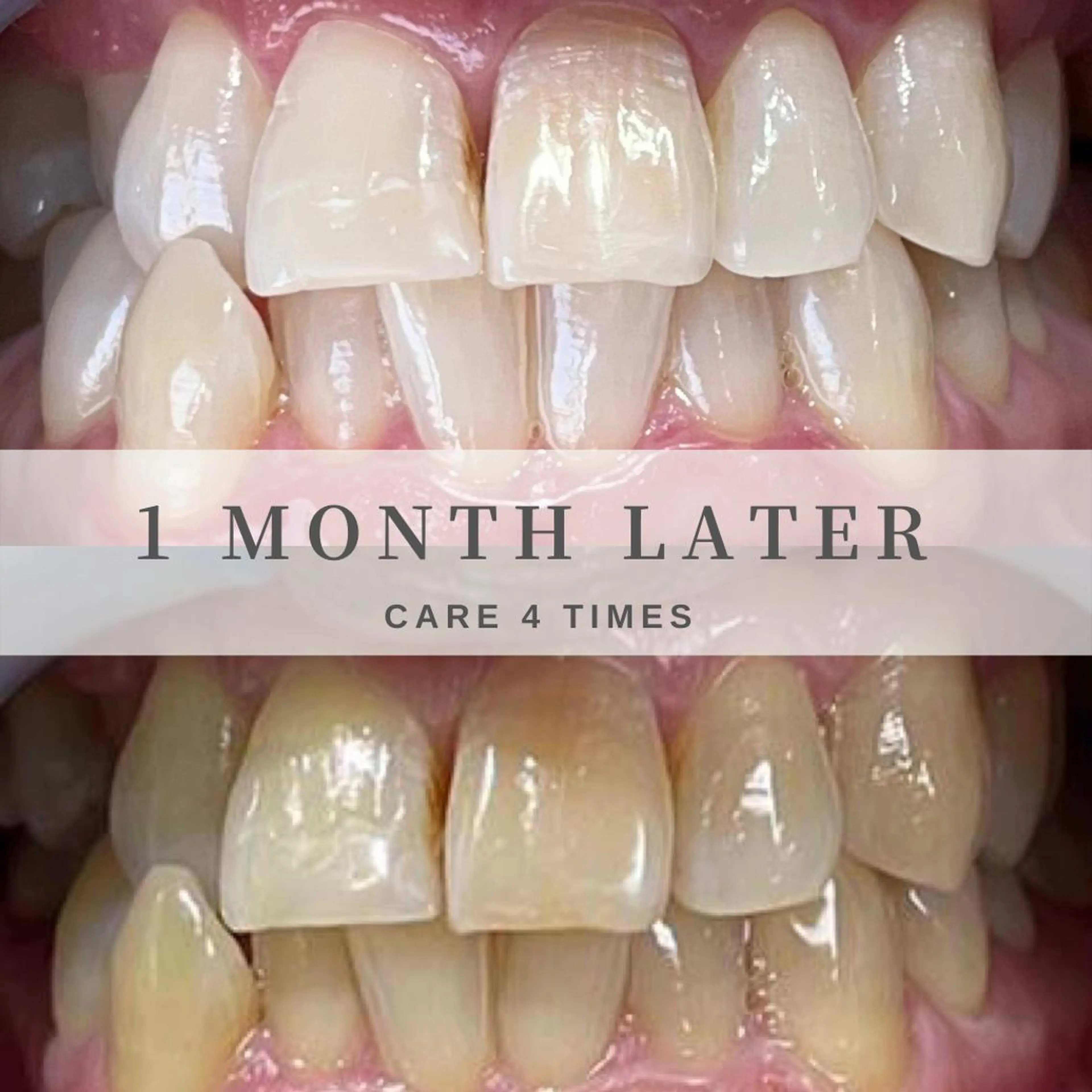 HaHaHa ホワイトニングのその他イメージ