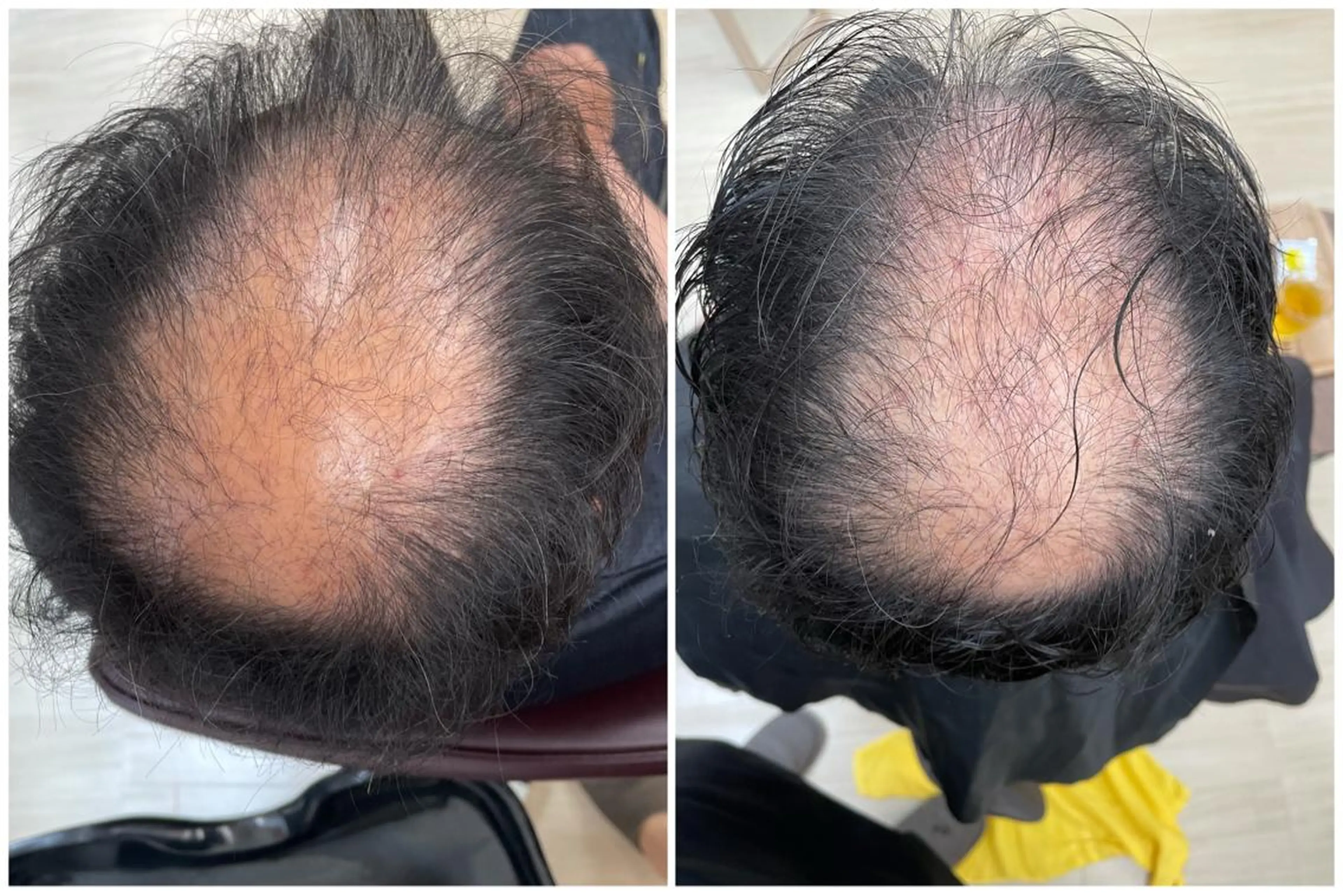 水素スパ🧖‍♀️間葉系幹細胞配合！！の写真