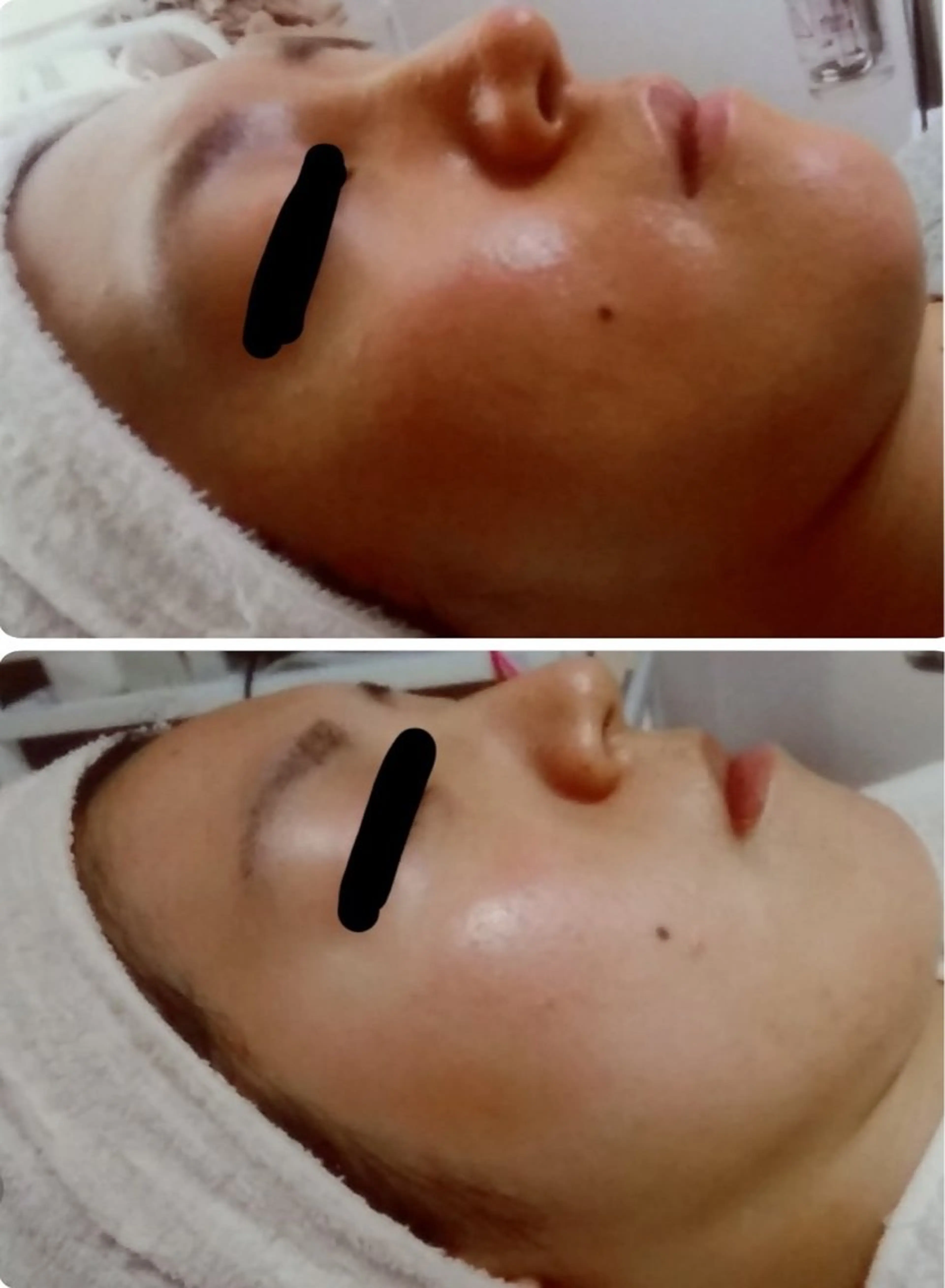 ニキビケア◇ニキビ跡 レゾン京橋店 八崎のエステ・リラクイメージ