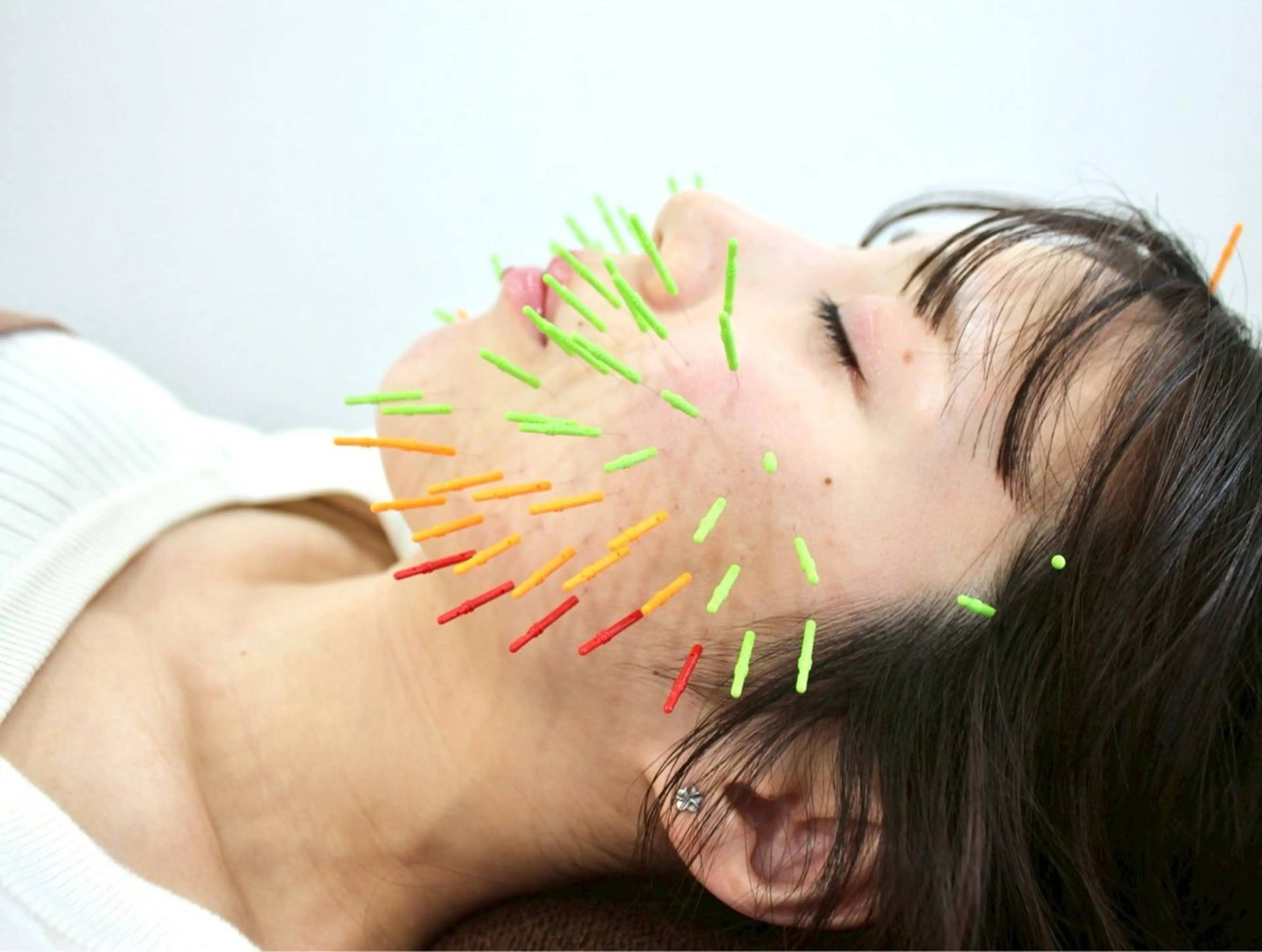 百美鍼:美容鍼100本（リフトアップ/小顔/ほうれい線/しわ/たるみ/毛穴の開き）(70分)の写真