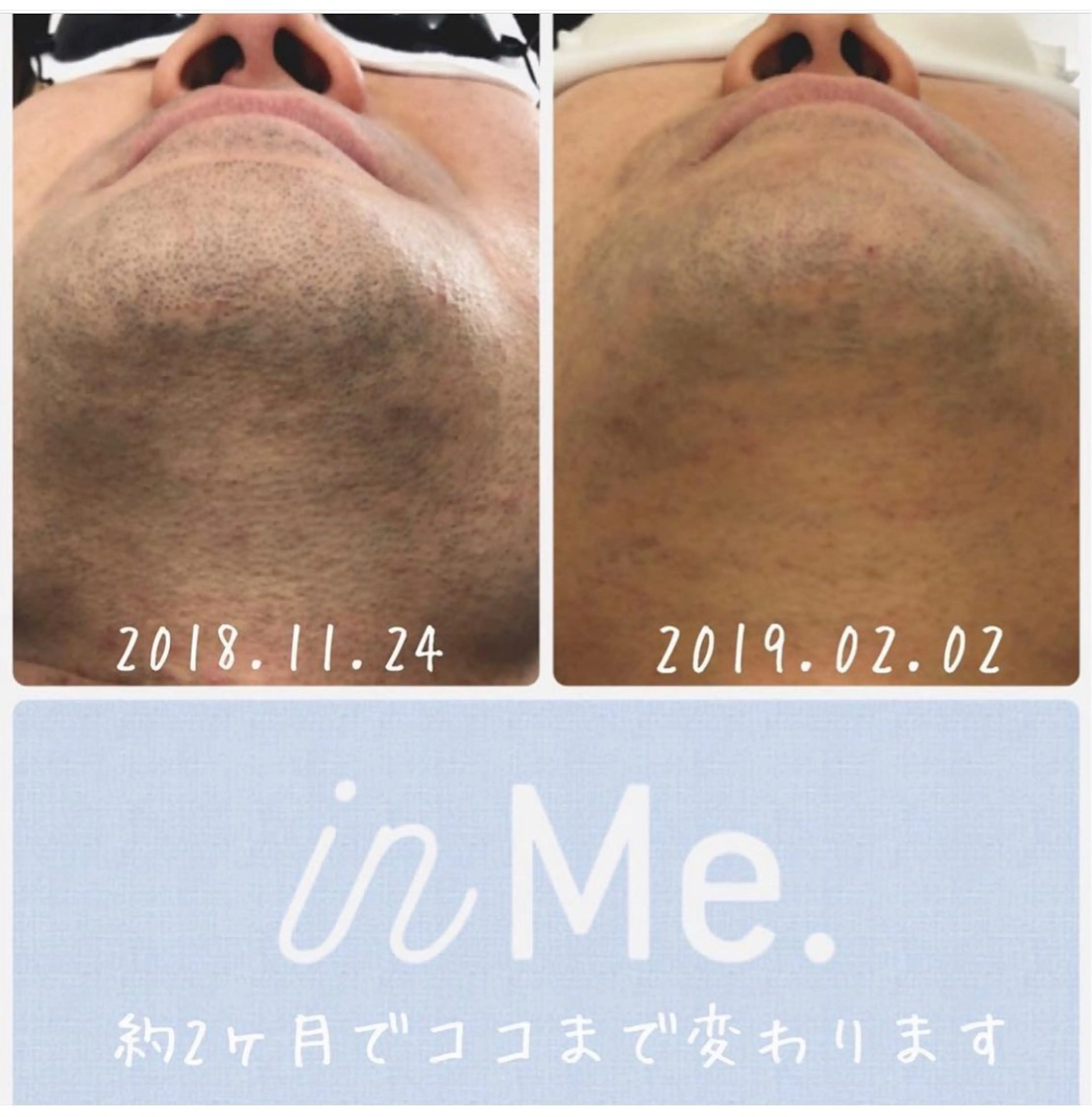 メンズ 脱毛 ◆つど払い脱毛◆ in Me.インミーのエステ・リラクイメージ