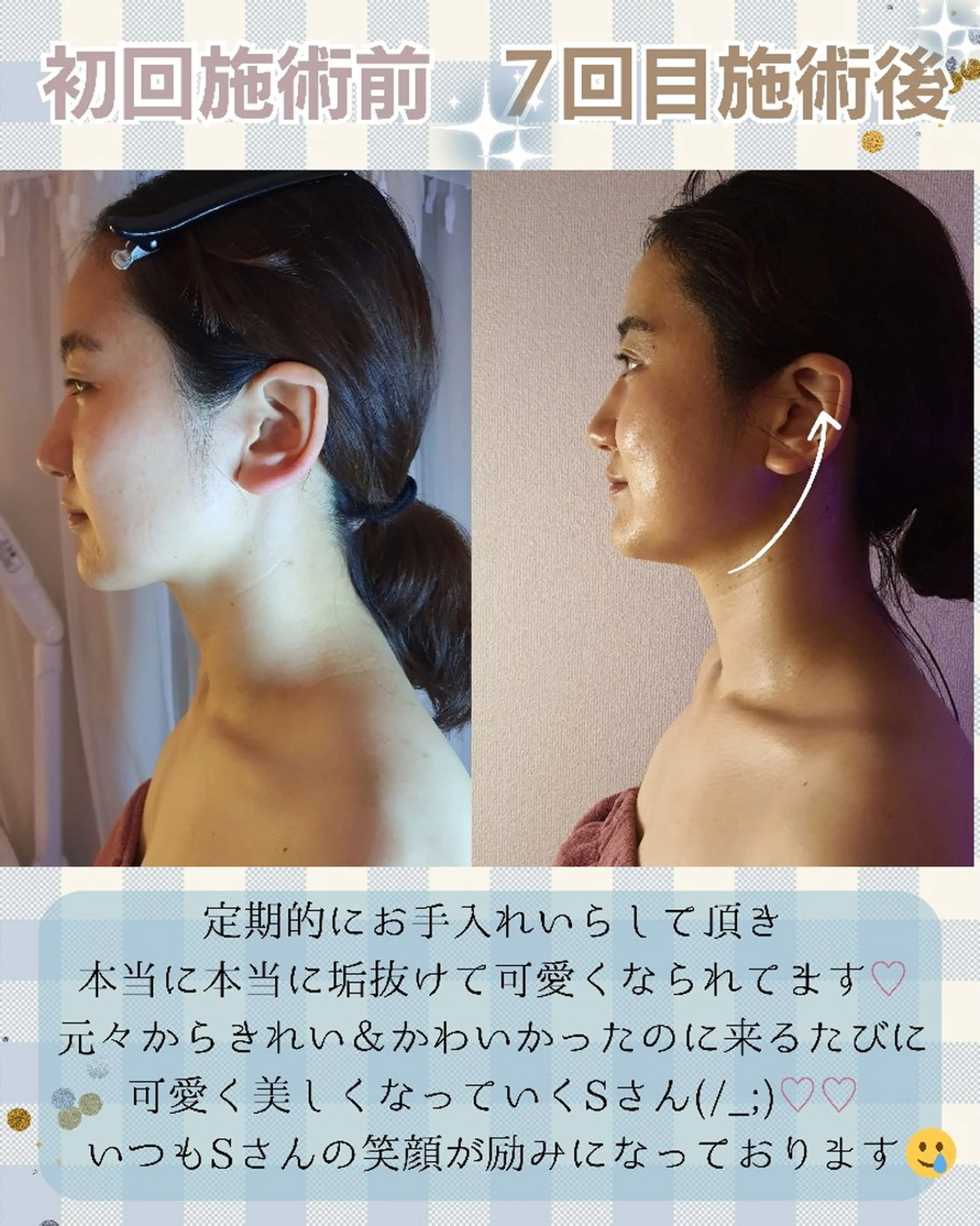 痩身ハーブピーリング 筋膜リリース☆B&Hのエステ・リラクイメージ