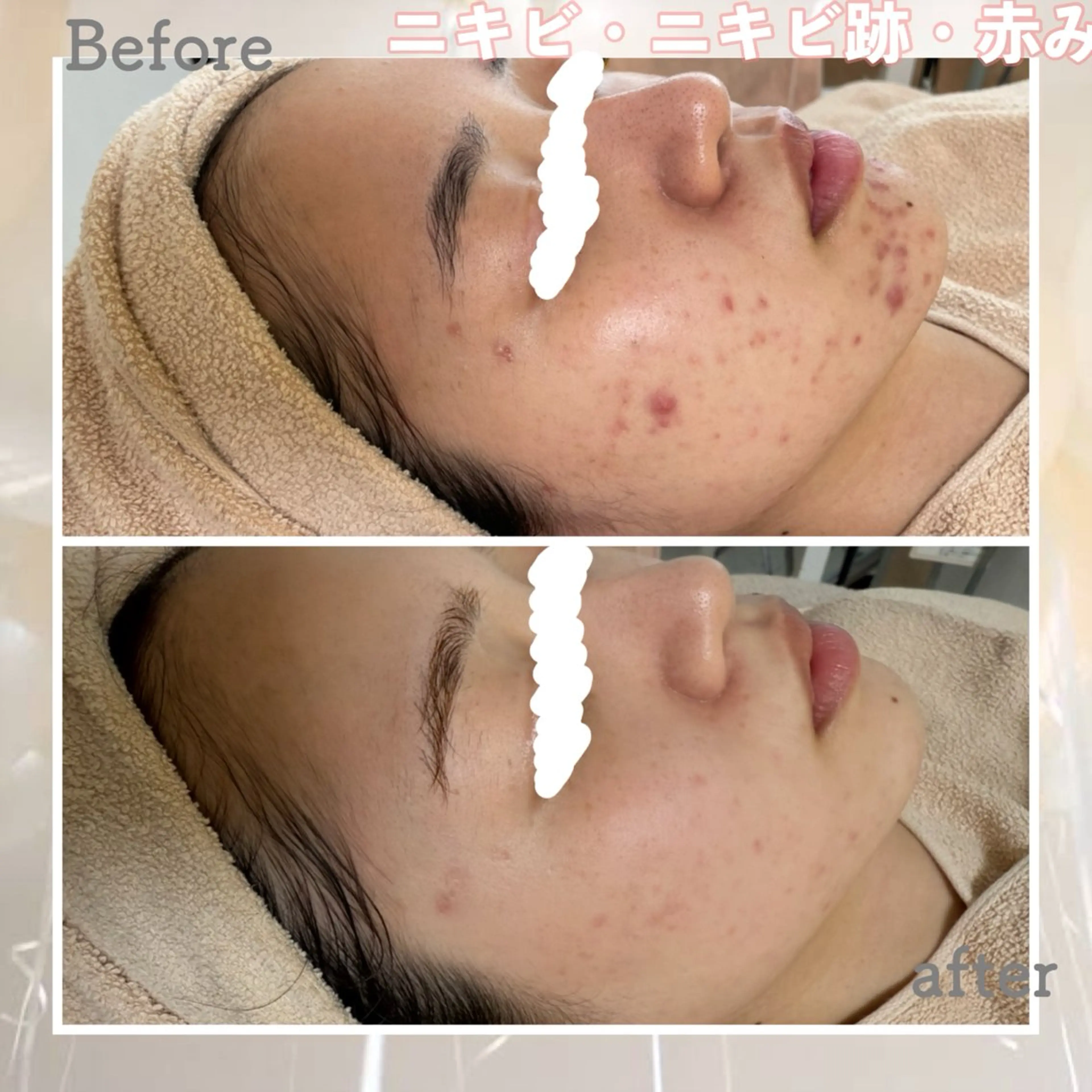 エステ ニキビ&跡改善サロン オーナー光木のエステ・リラクイメージ