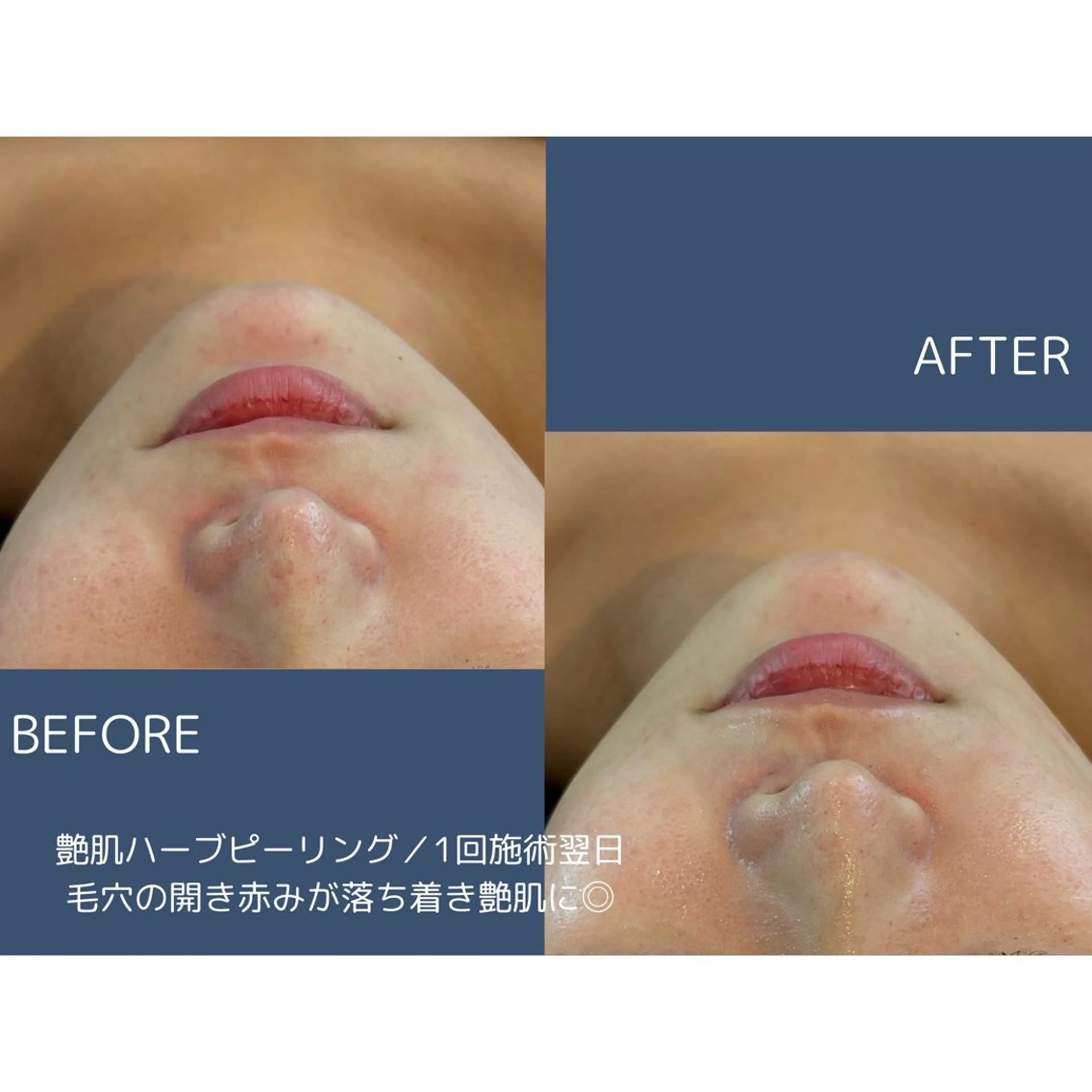 エステ リラク 艶肌ハーブピーリング /毛穴洗浄のエステ・リラクイメージ