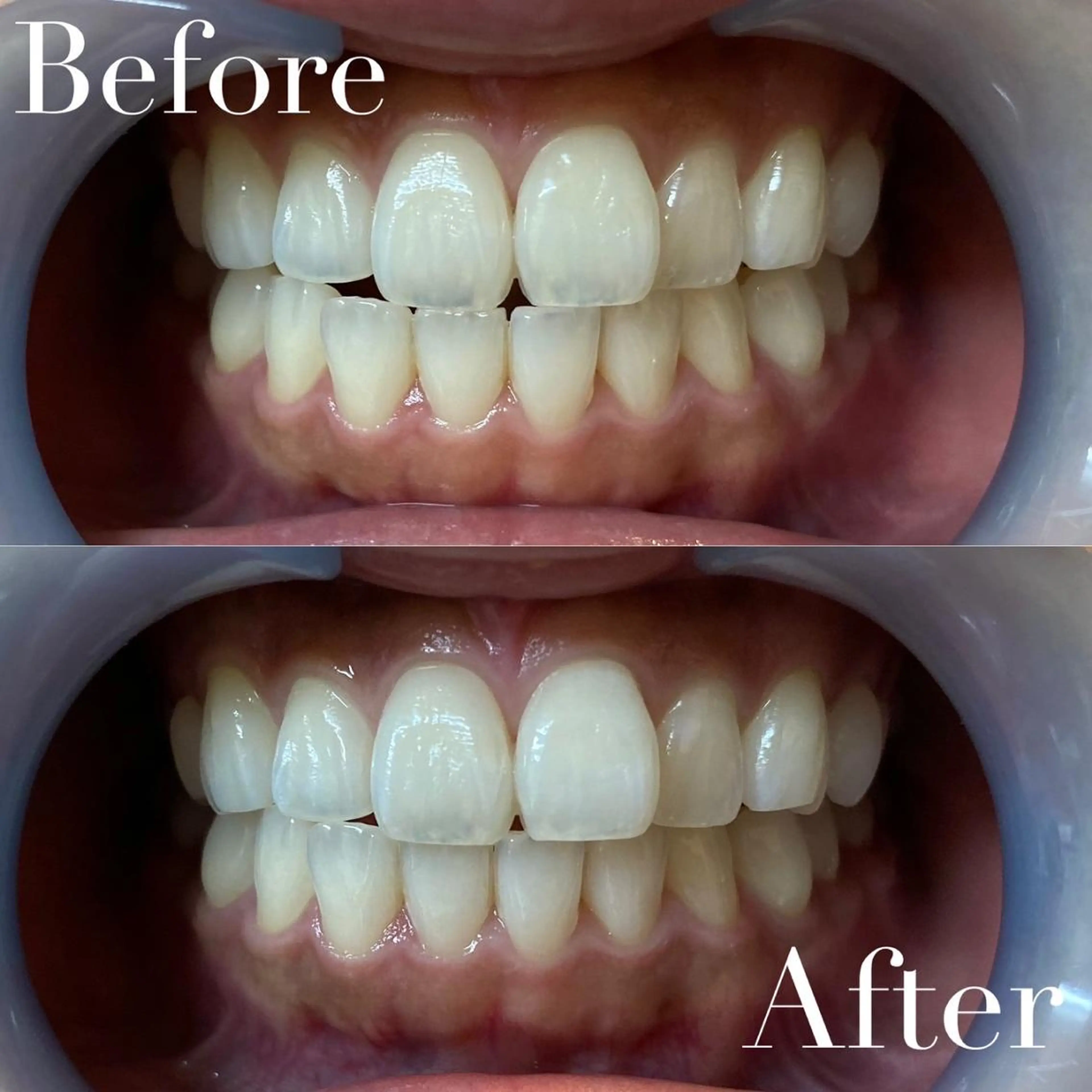 その他 LBSホワイトニング 新宿店💎公式のその他イメージ