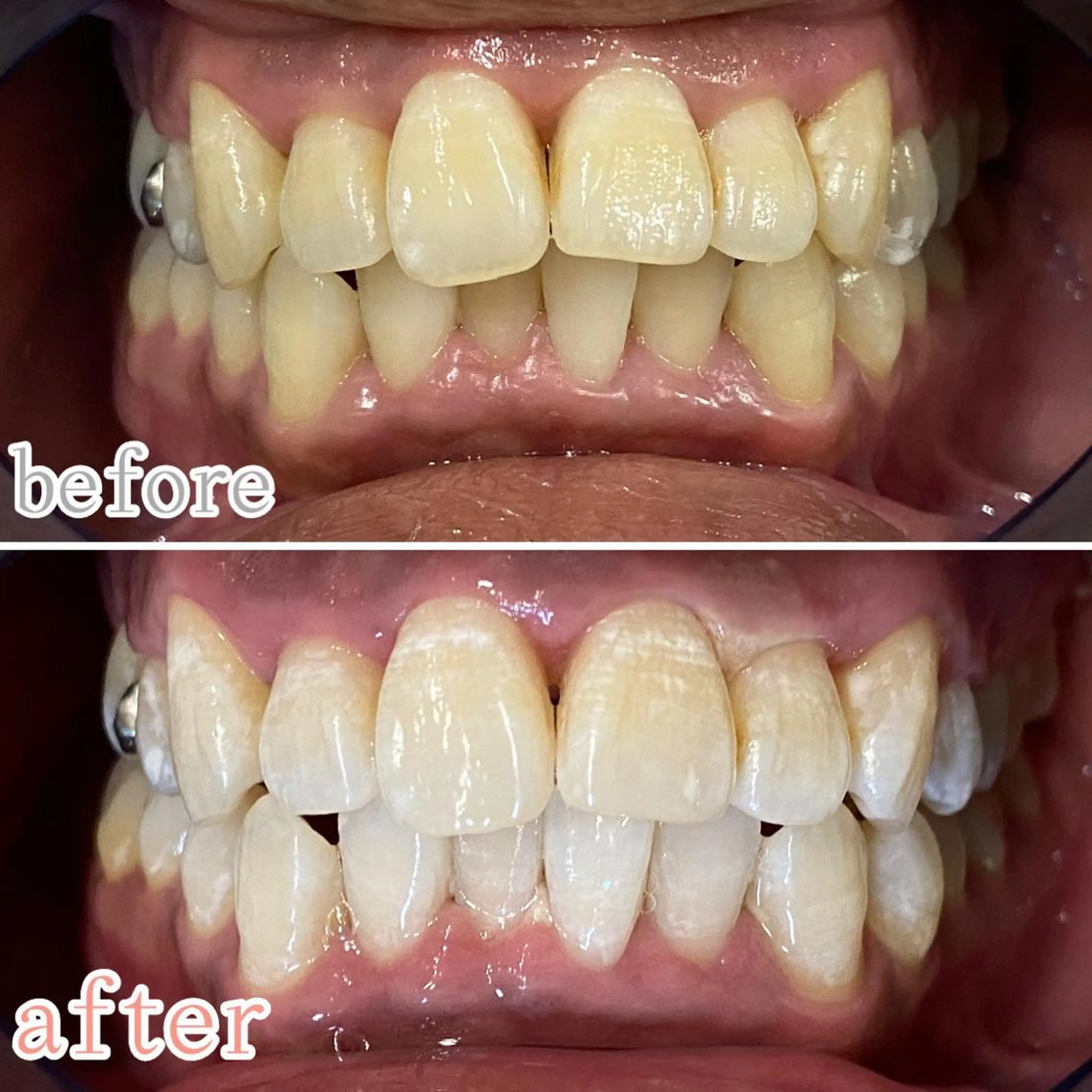 その他 ホワイトニングサロン CREWのその他イメージ