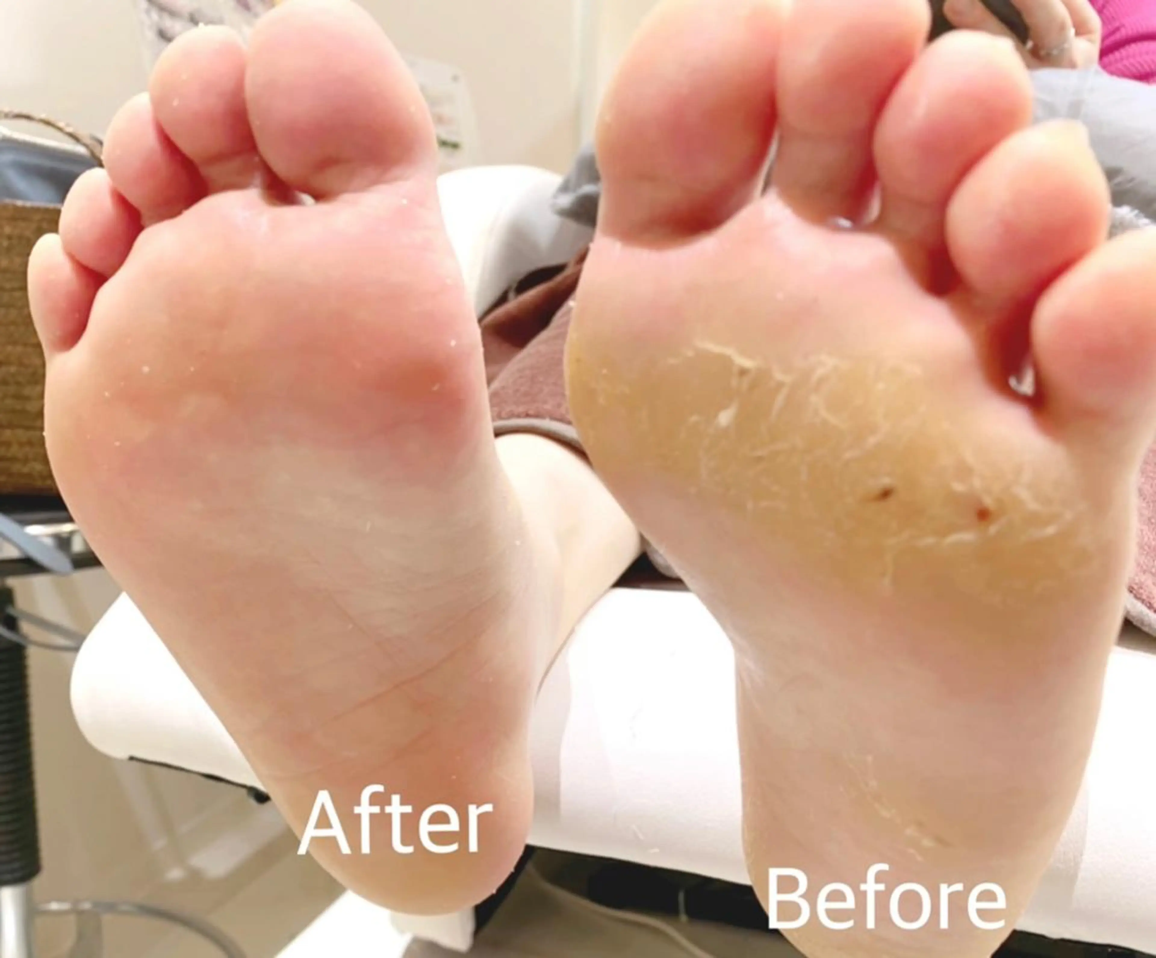 【💙全員💙フット角質ケア】の写真
