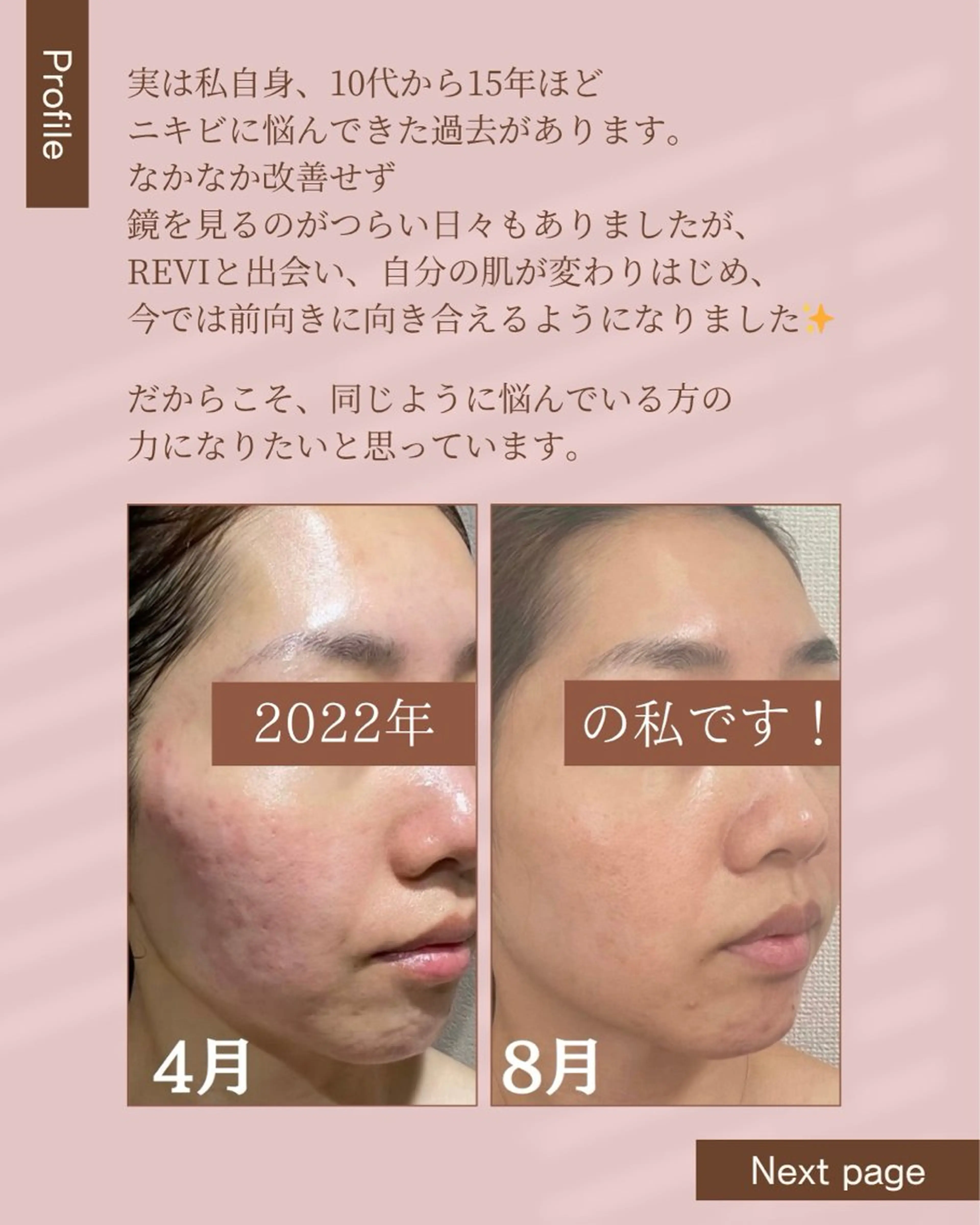 【大人ニキビ卒業フェイシャル】REVI陶肌トリートメント🌿ダウンタイムなしハーブプーリングの写真