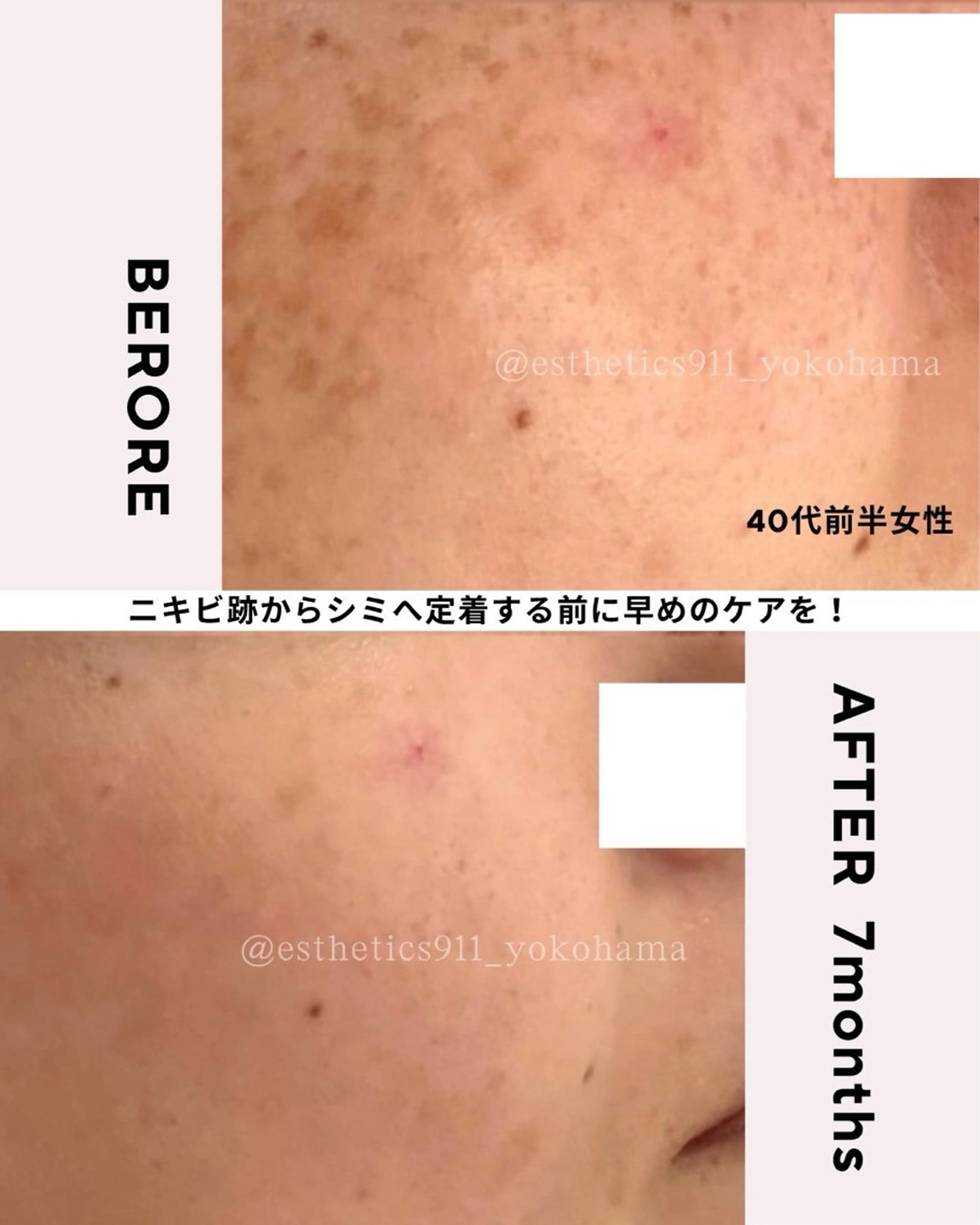 【全営業時間】肌荒れ解決！シミくすみケア！水素高周波のWアプローチ！フェイシャルエステ体験の写真