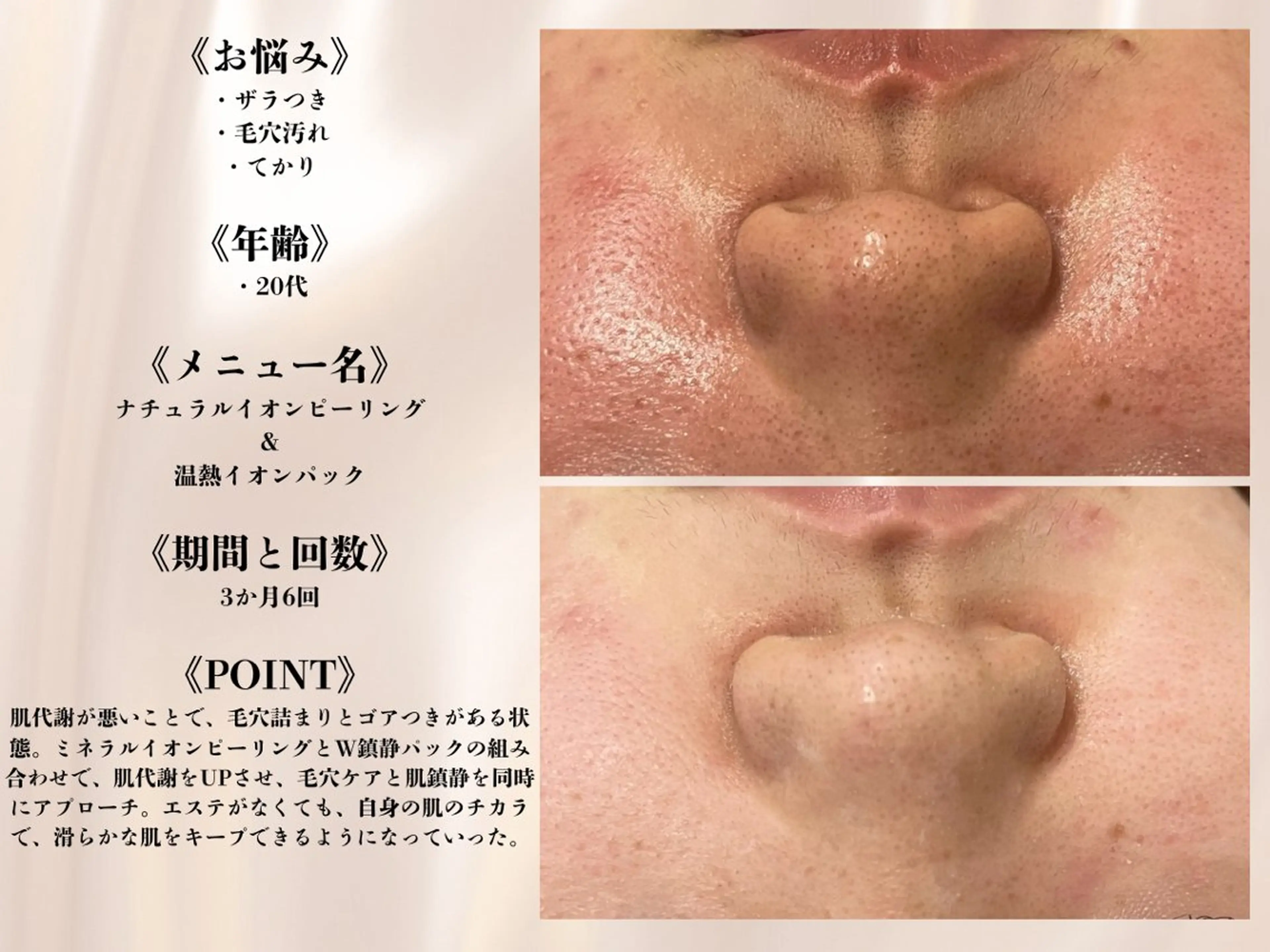 エステ リラク ニキビ跡改善専門🔥 医療にはできない改善のエステ・リラクイメージ