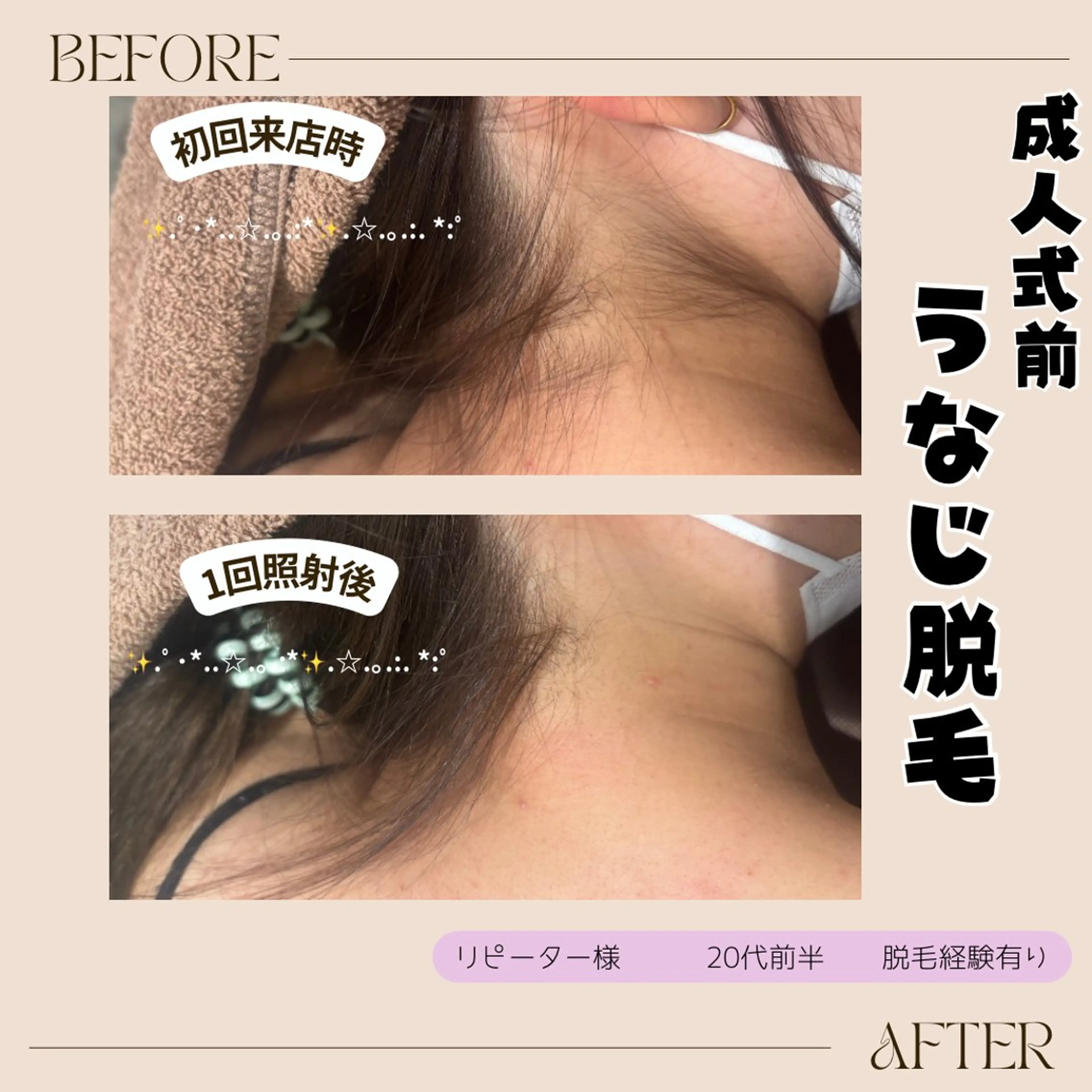 脱毛 lieupré 脱毛 oshima‎⌣̈のエステ・リラクイメージ