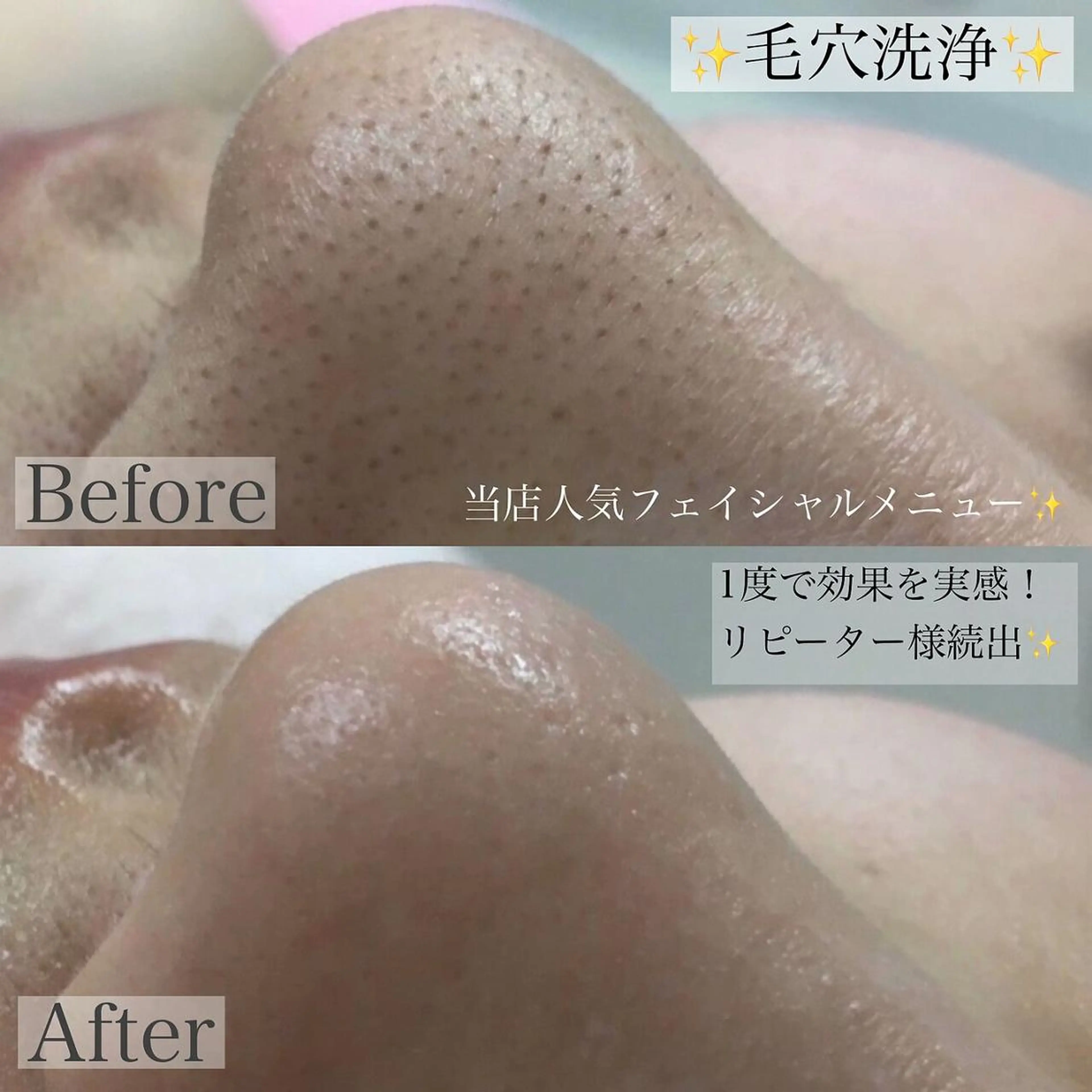 【毛穴の黒ずみ撃退！】毛穴洗浄◎毛穴汚れをゴッソリ綺麗に♪の写真