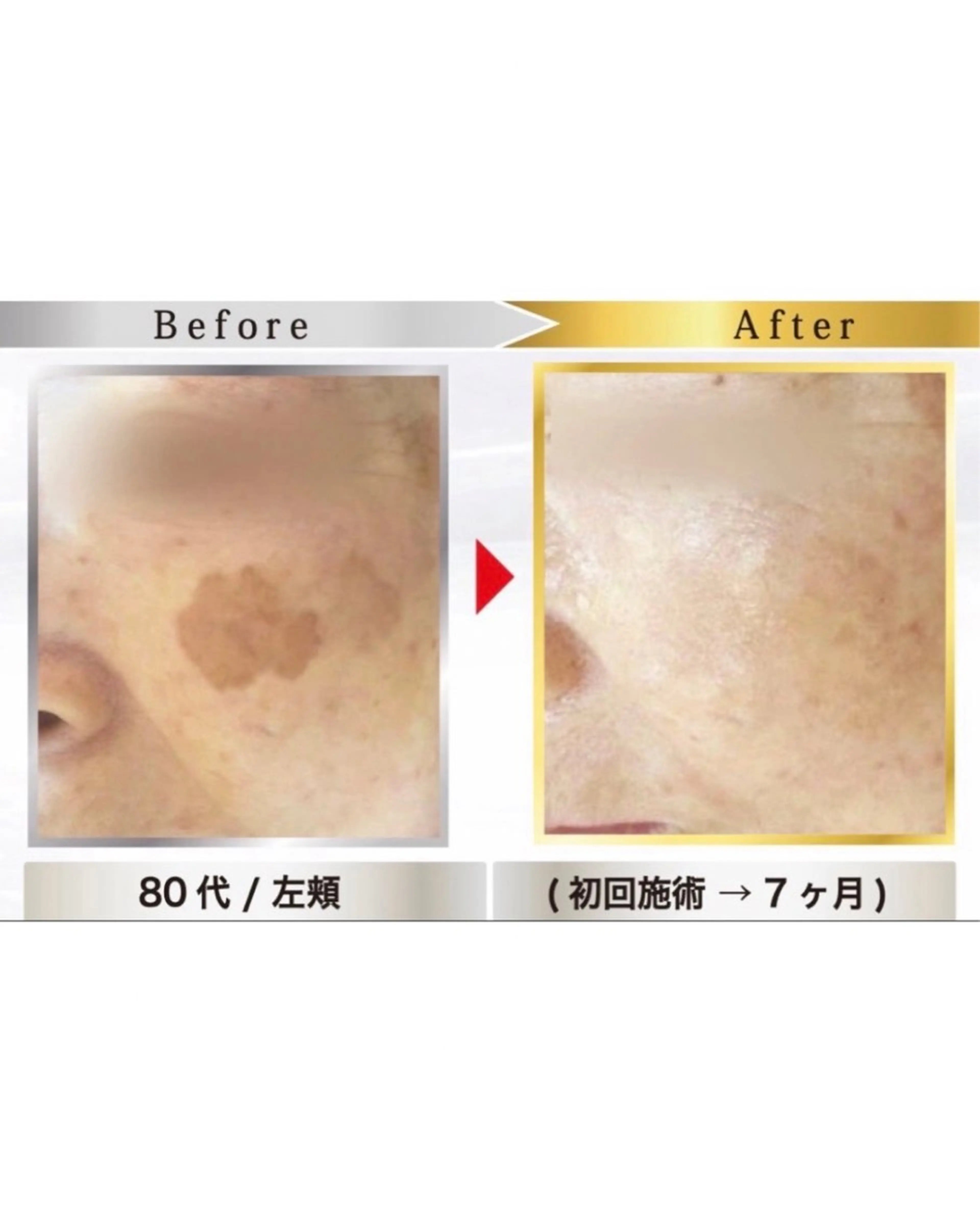 地域No.1👑本気のシミケア放題✨デコルテマッサージ付きの写真