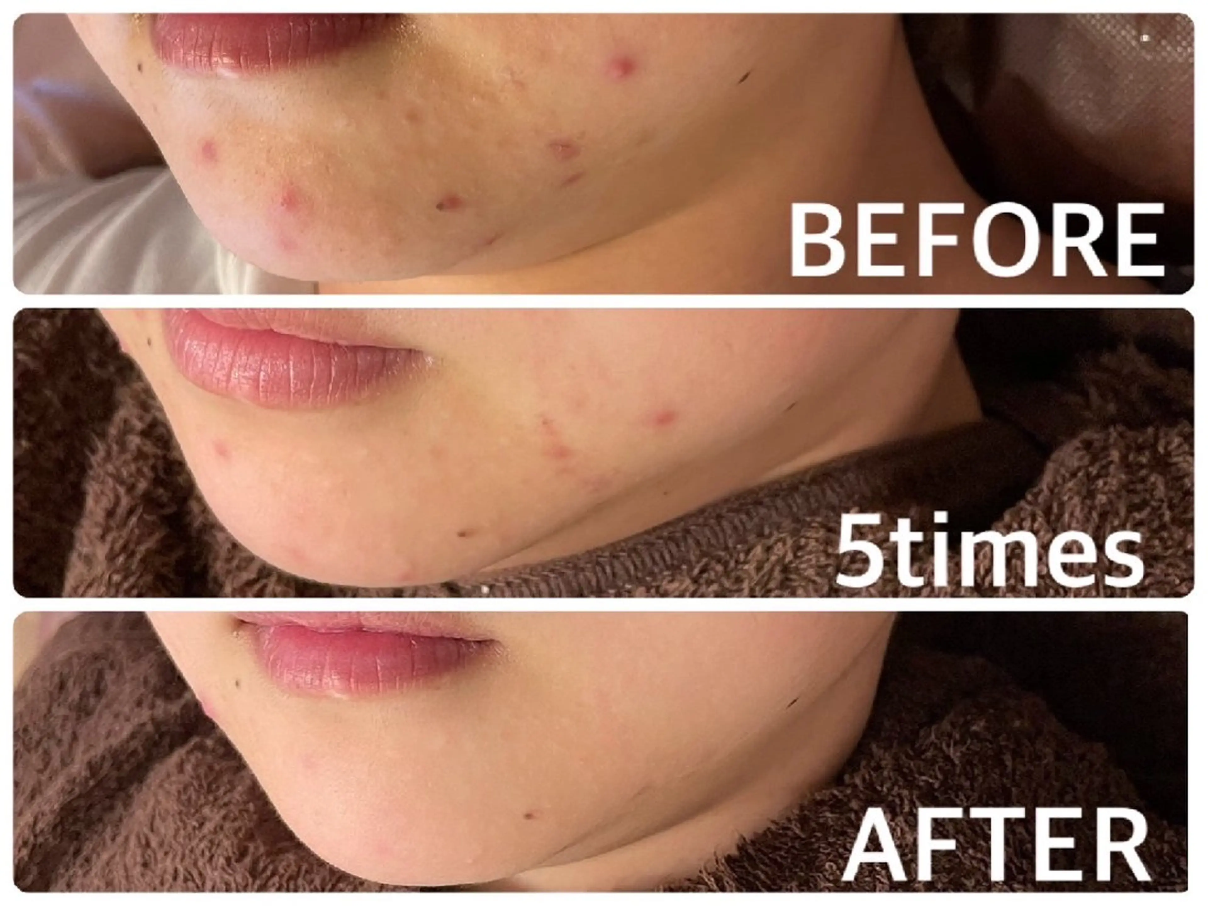 肌質改善ハーブピーリングの写真