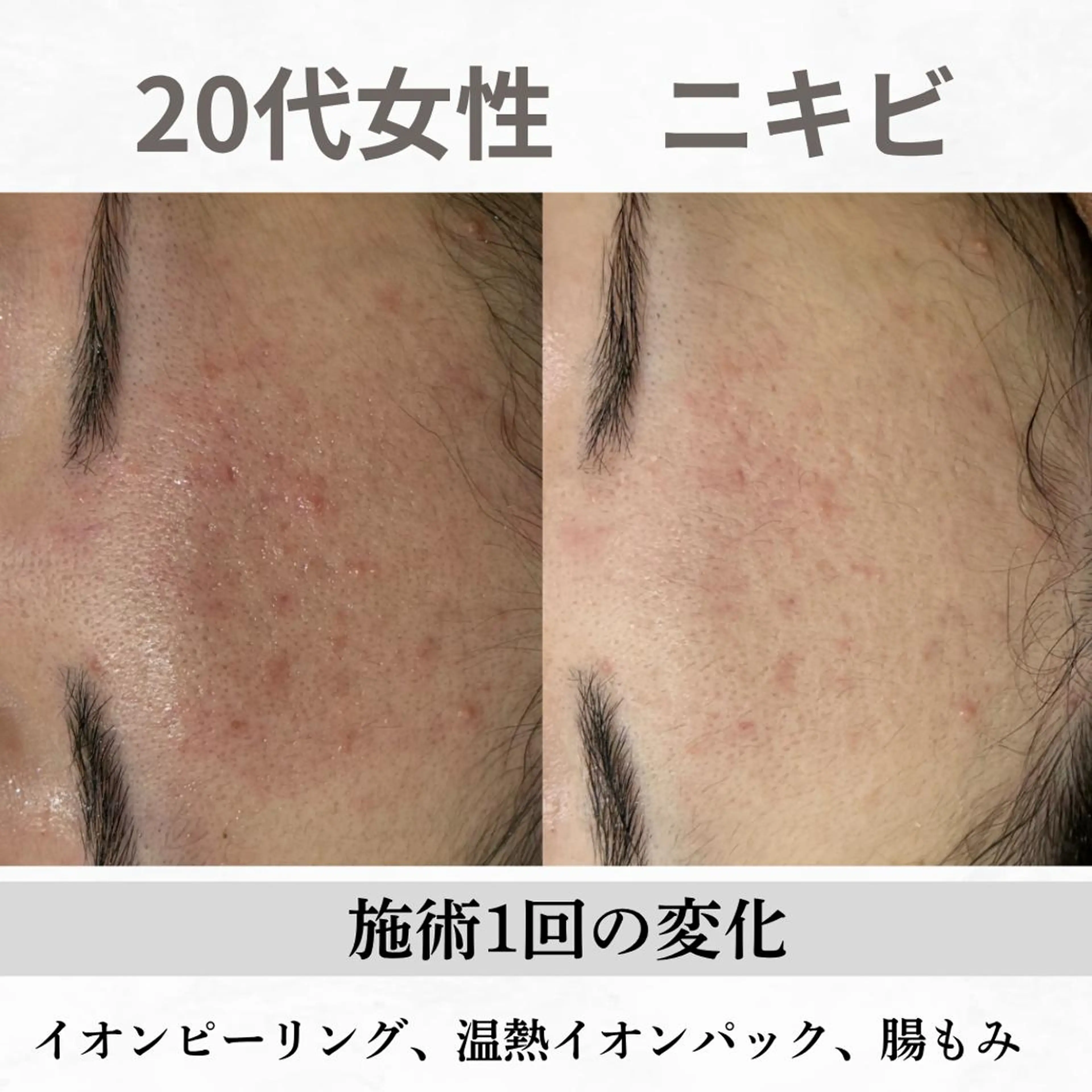 重度ニキビ専門🌷 ダウンタイムなしのエステ・リラクイメージ
