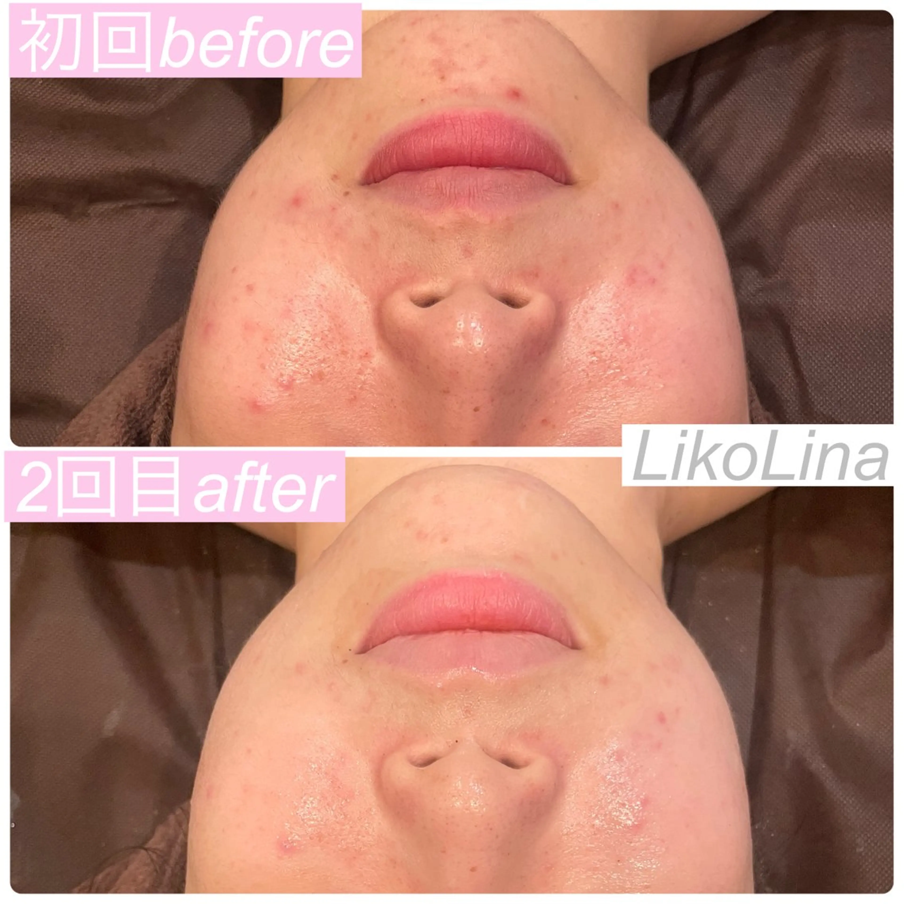 エステ 肌育脱毛サロン LikoLinaのその他イメージ