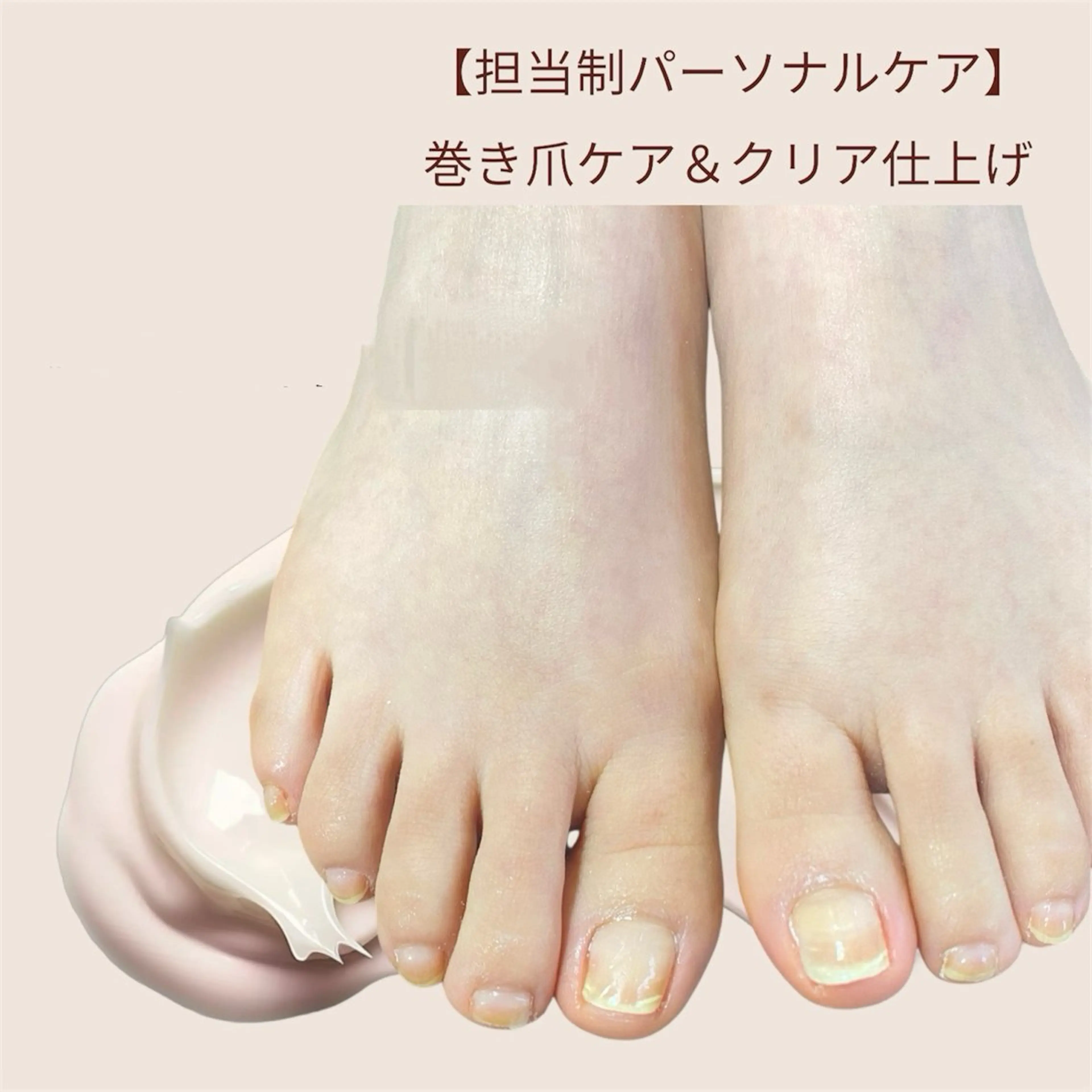 【担当制パーソナルケア】フット・巻き爪ケア・クリアネイル仕上げの写真