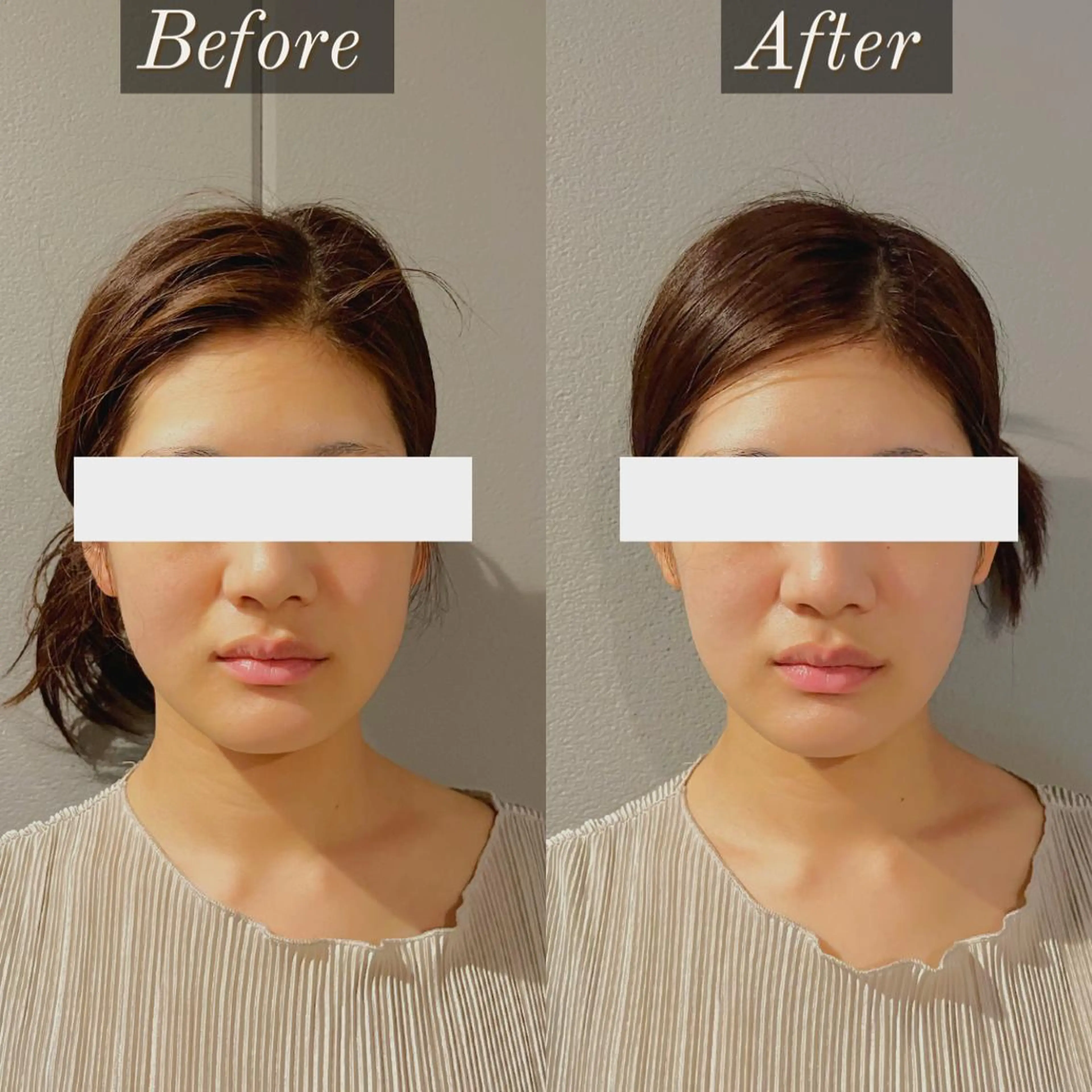 【バレンタイン🈹】究極の小顔に◎ ［コルギ×美容鍼］美容形成鍼灸　90分　¥11980→¥6980の写真